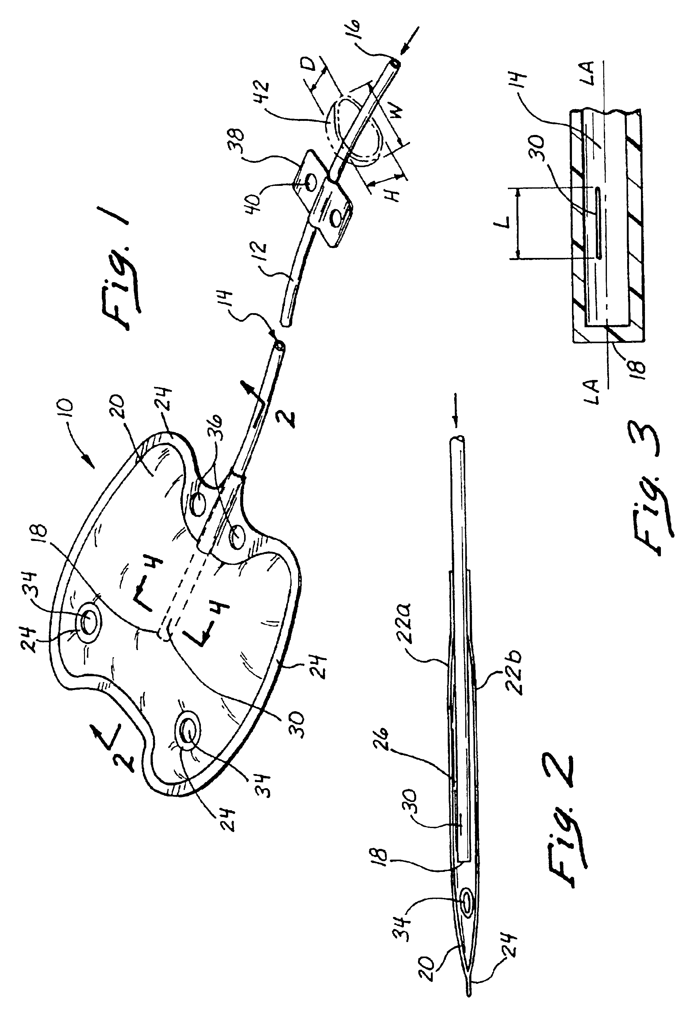 Sutureless implantable device and method for treatment of glaucoma