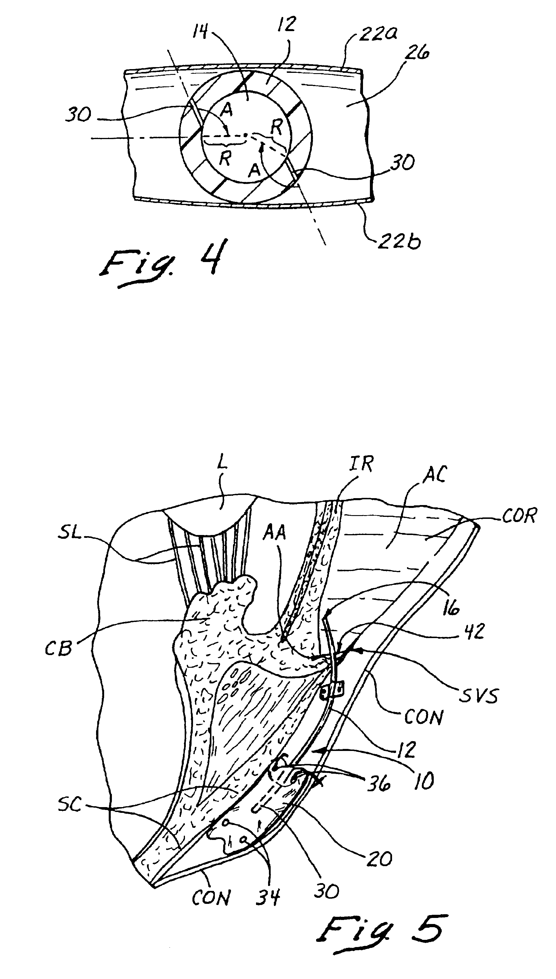 Sutureless implantable device and method for treatment of glaucoma