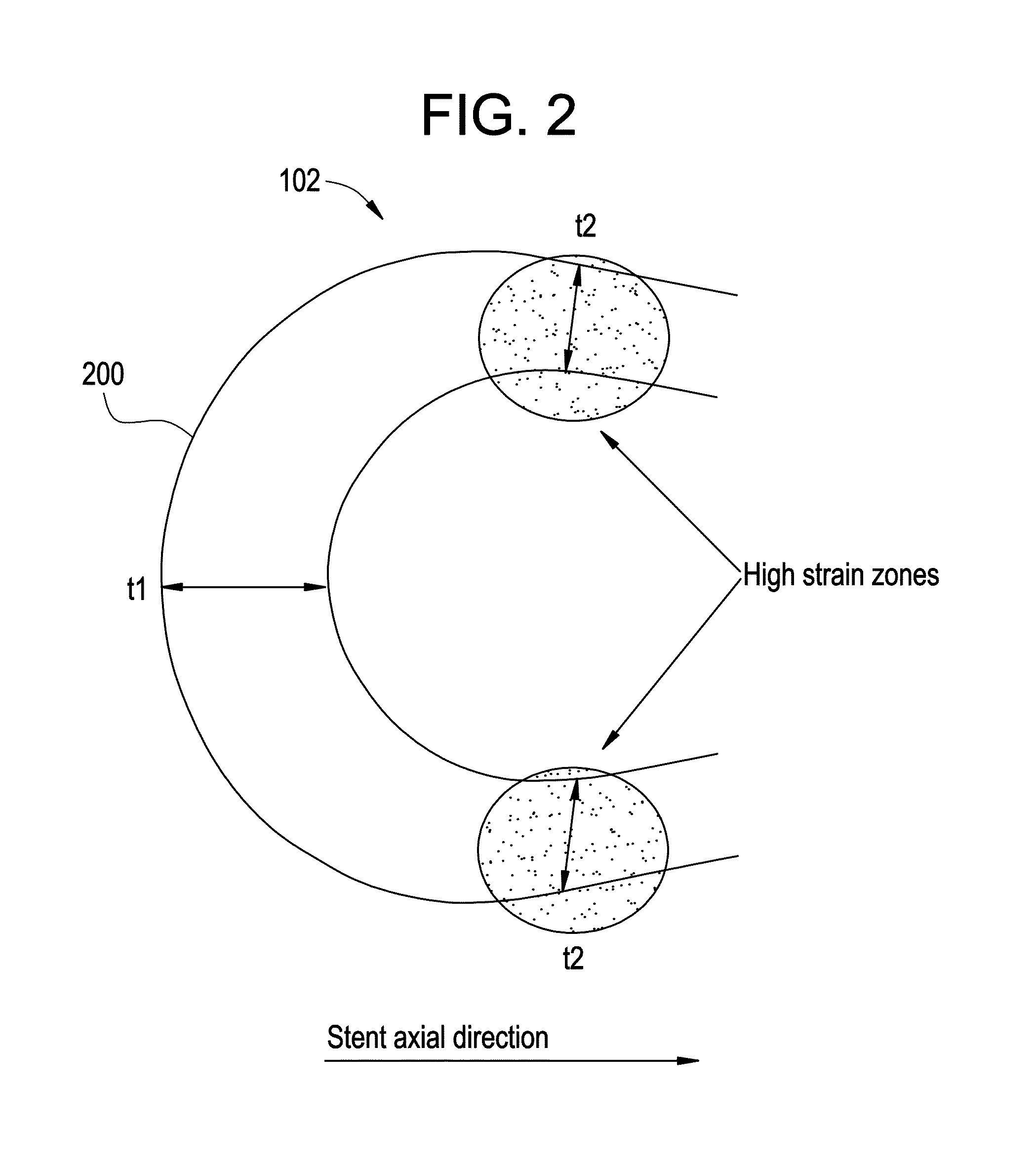 Balloon expandable bioabsorbable drug eluting flexible stent