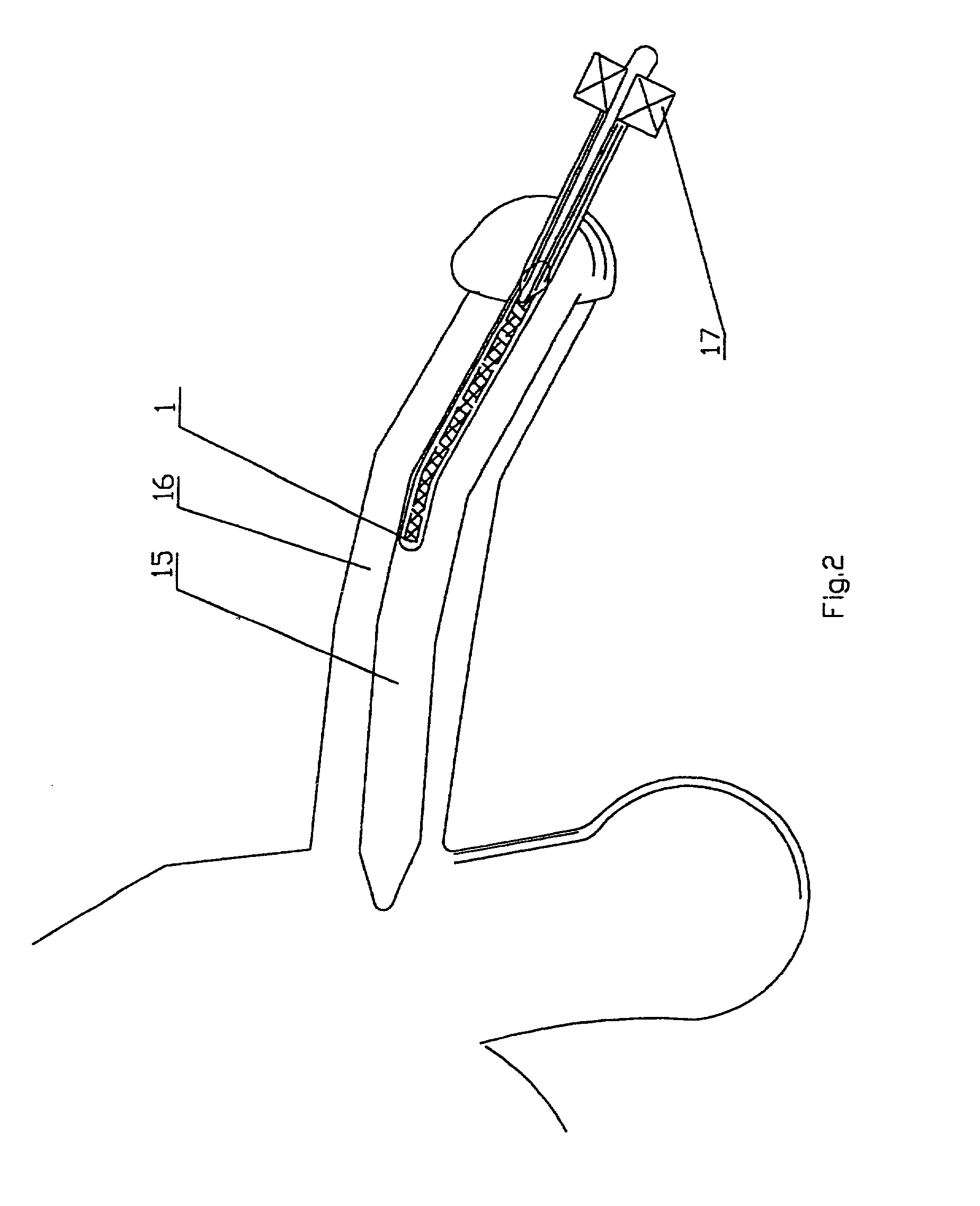 Penile prosthesis and method of implantation