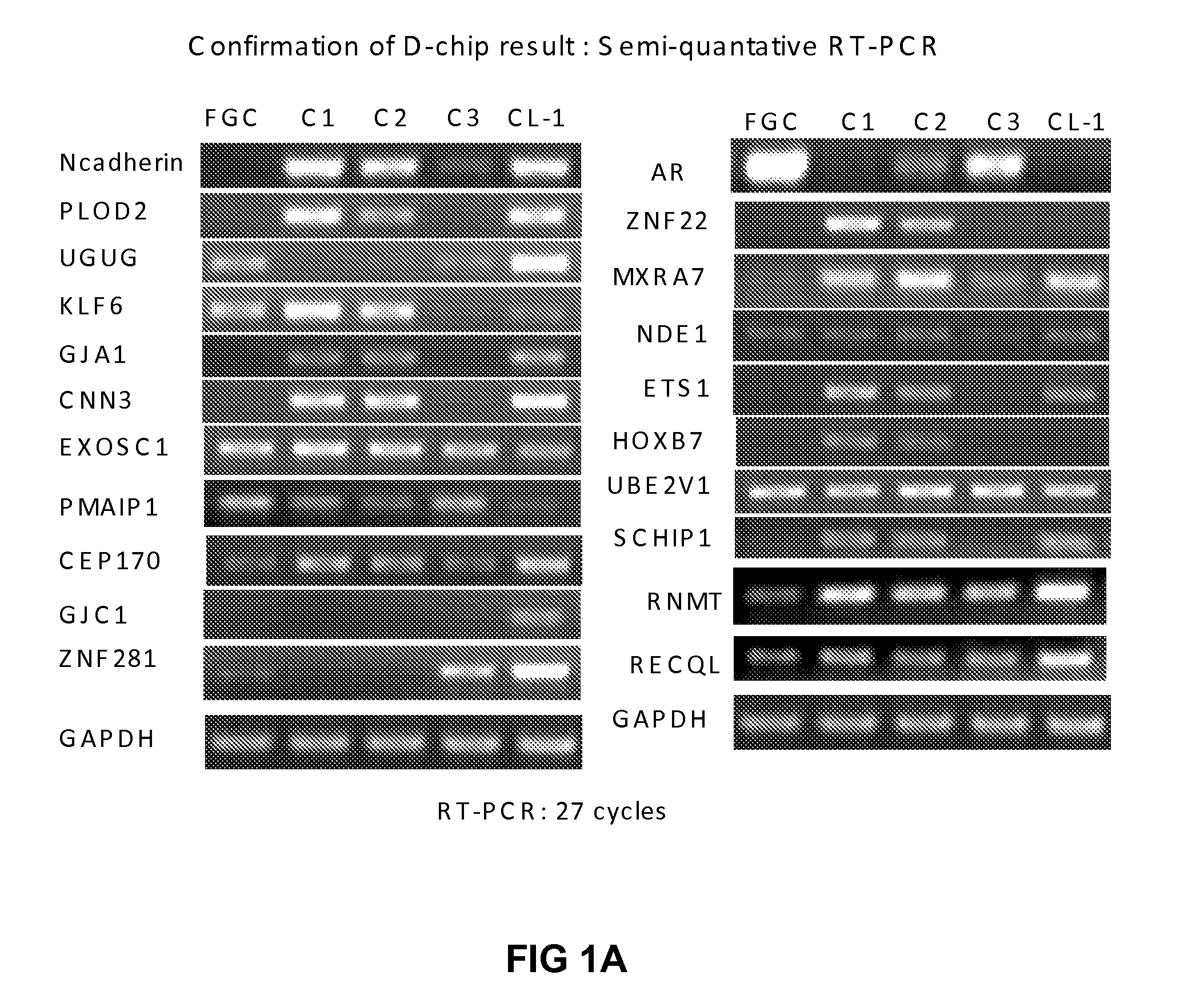 Novel diagnostic and therapeutic targets associated with or regulated by n-cadherin expression and/or epithelial to mesenchymal transition (EMT) in prostate cancer and other malignancies