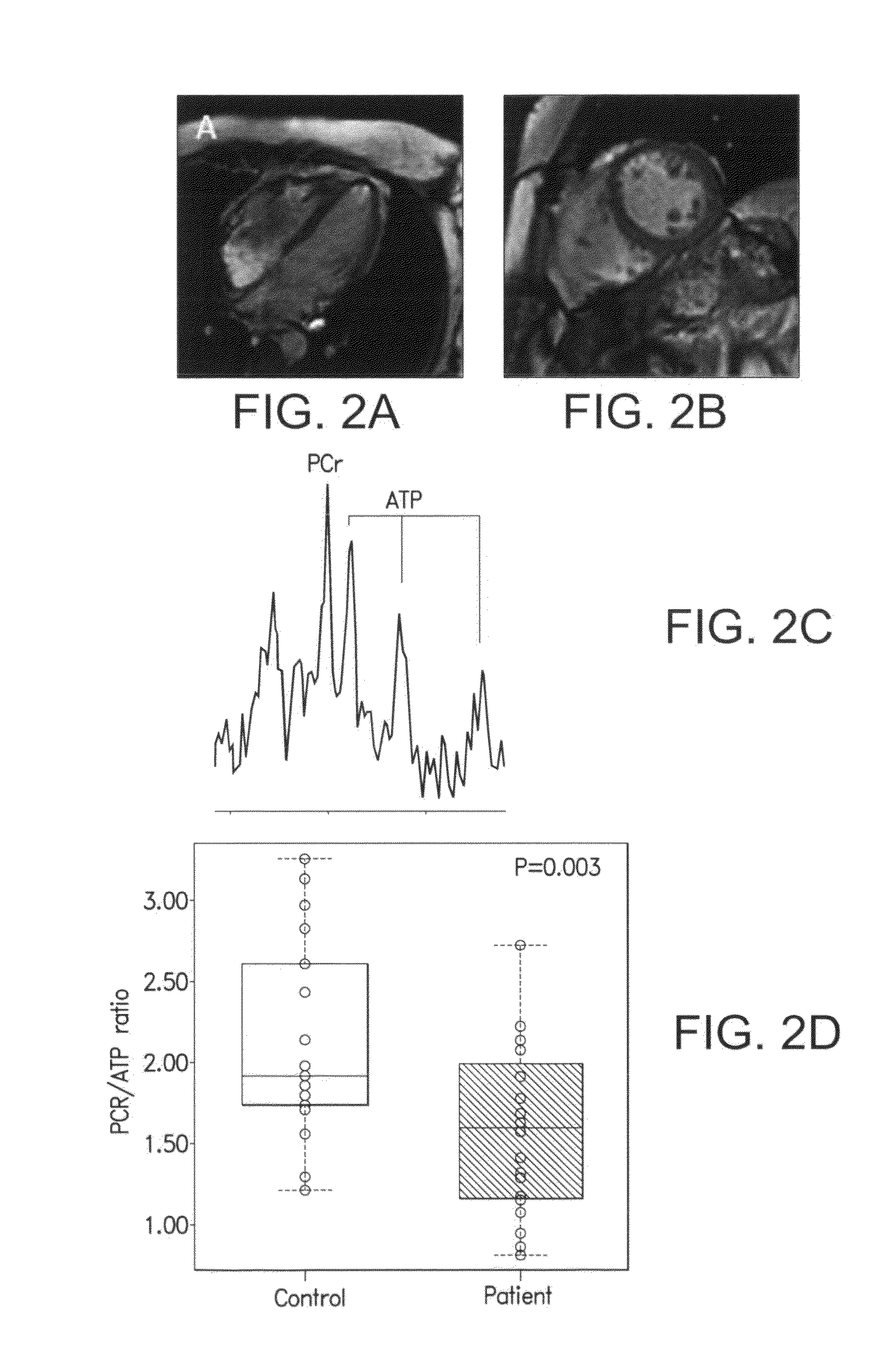 TREATMENT OF HFnEF