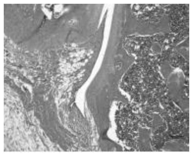 Transdermal drug delivery preparation for treating knee osteoarthritis and preparation method thereof