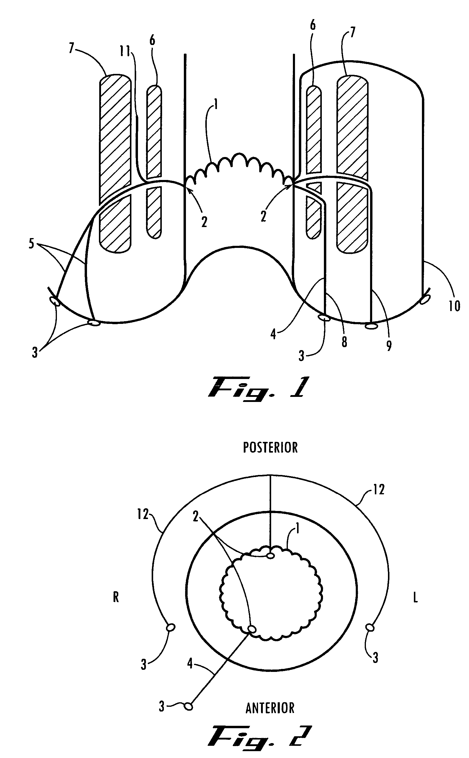 Instrument and method for endoscopic visualization and treatment of anorectal fistula