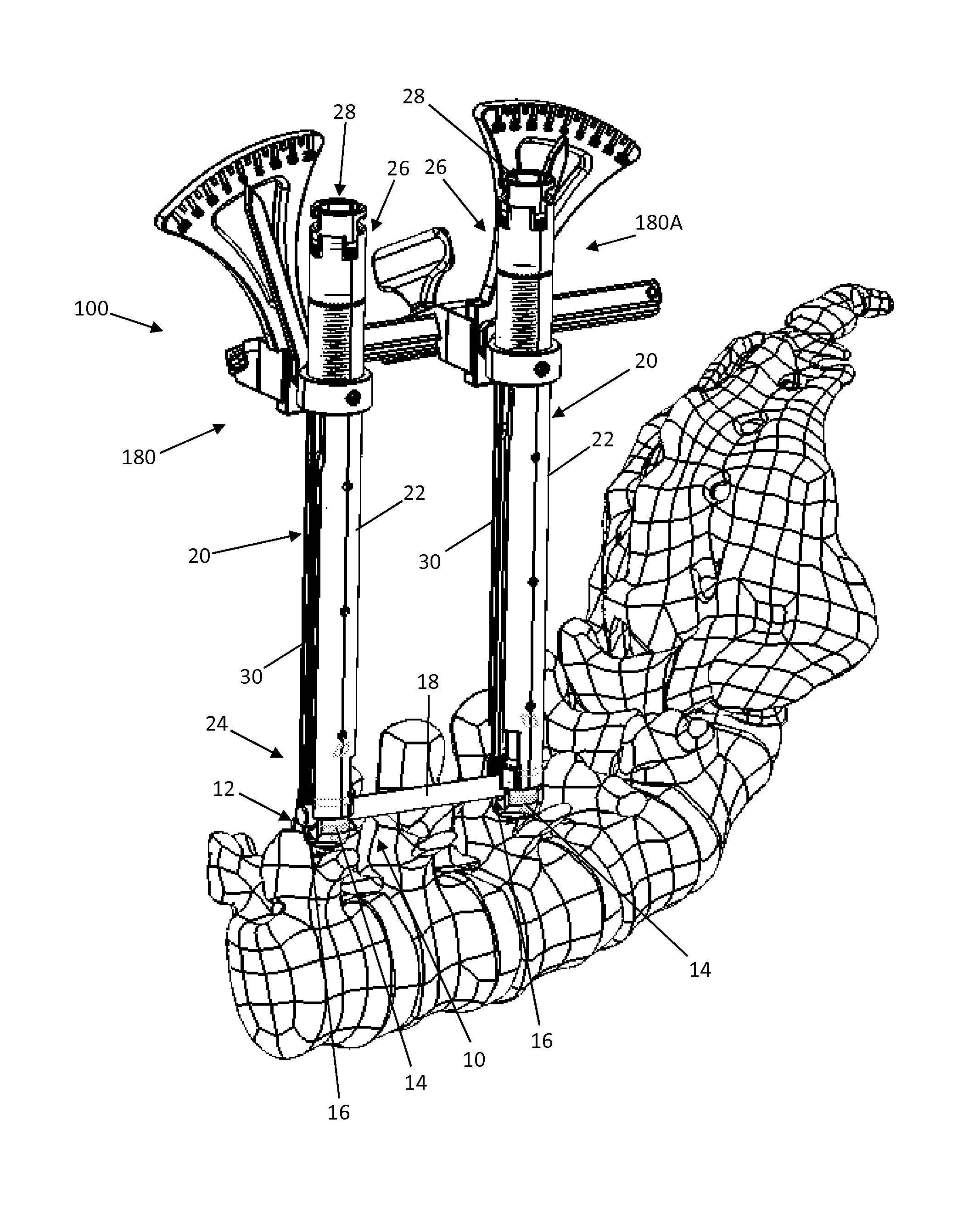 Spinal alignment frame