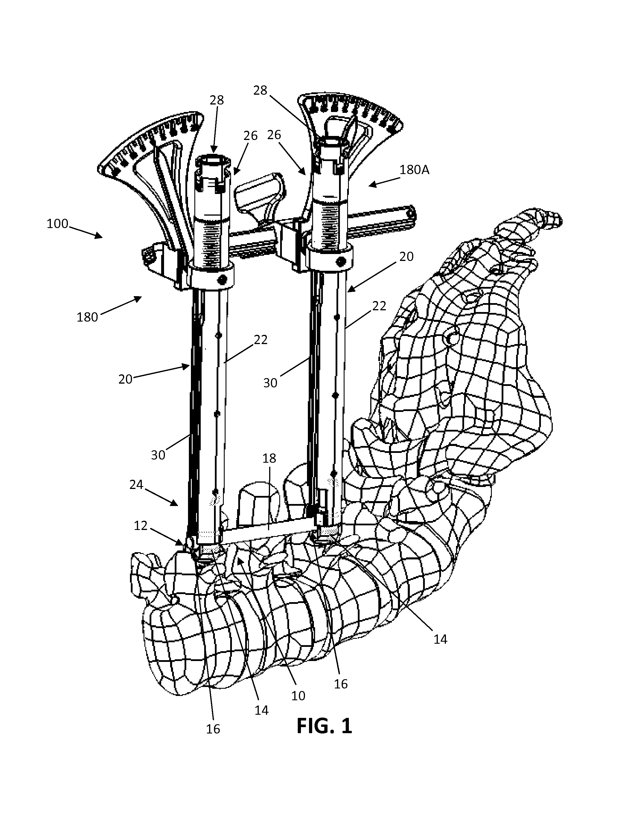 Spinal alignment frame