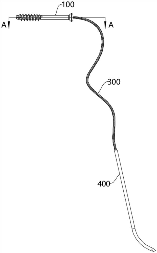 Patella fracture hollow screw cable locking system