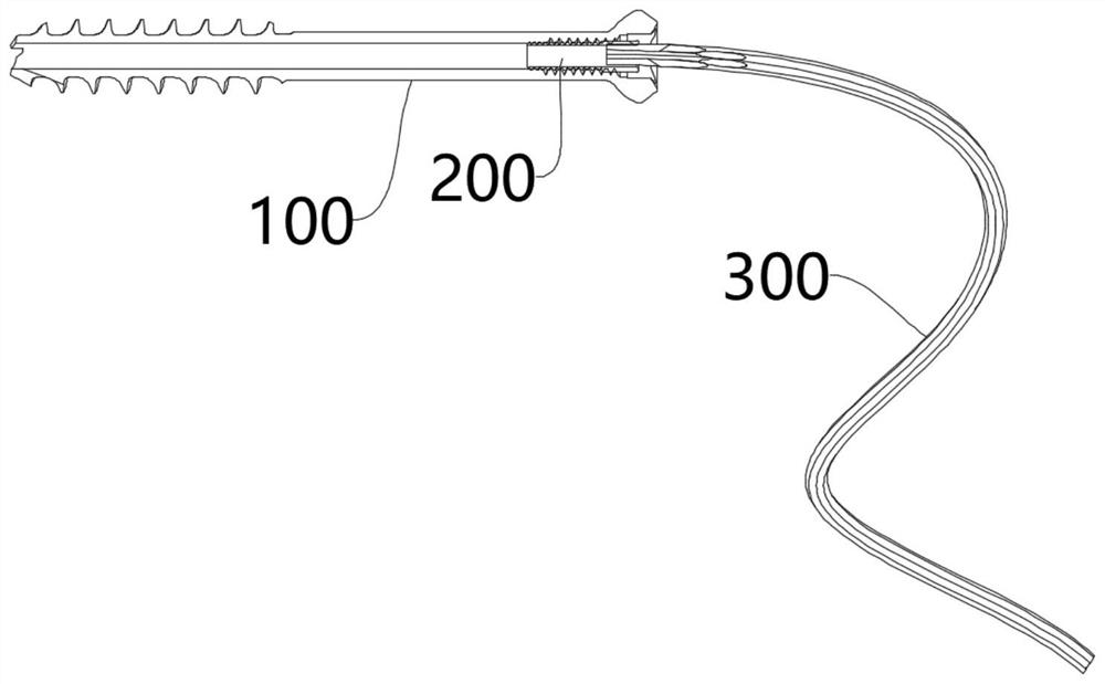 Patella fracture hollow screw cable locking system