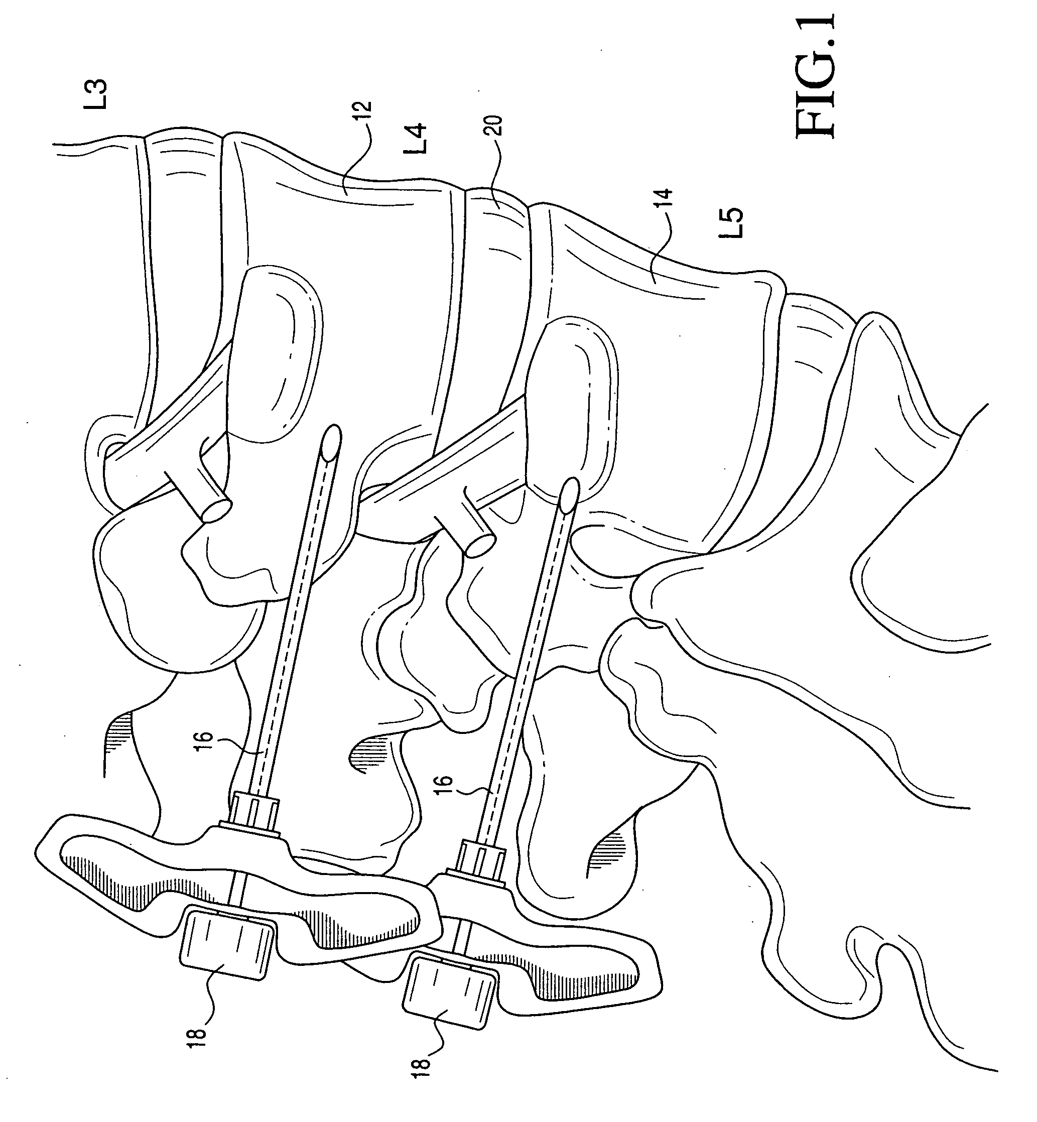 Percutaneous spinal stabilization device and method