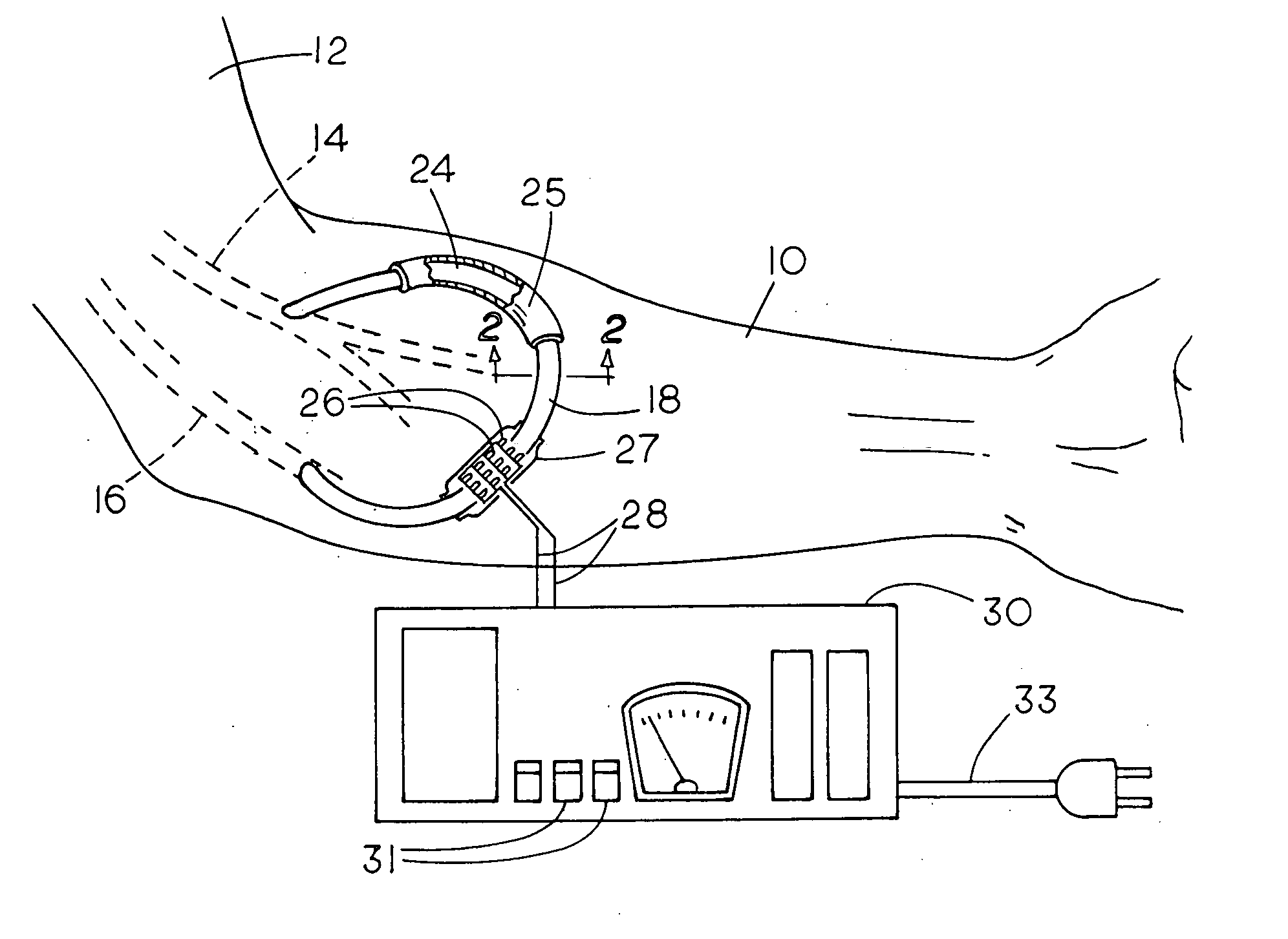 Method and apparatus for preventing dialysis graft intimal hyperplasia