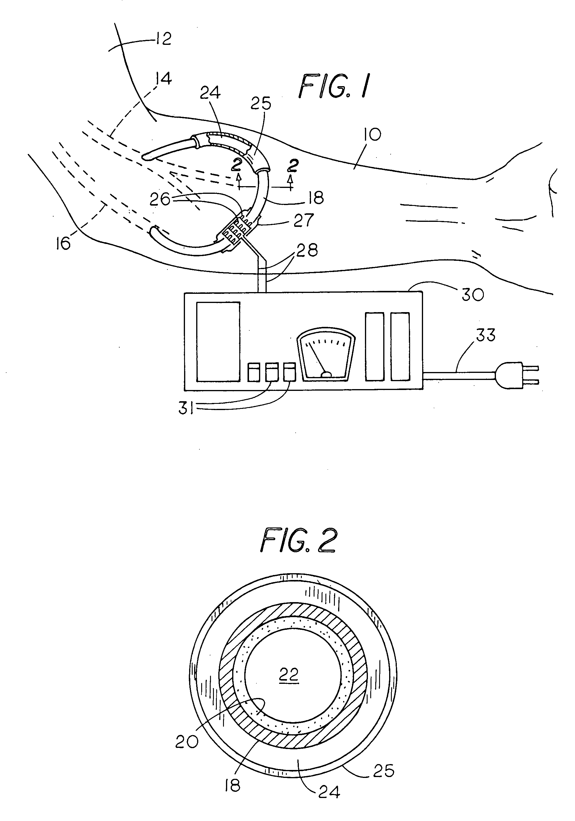 Method and apparatus for preventing dialysis graft intimal hyperplasia