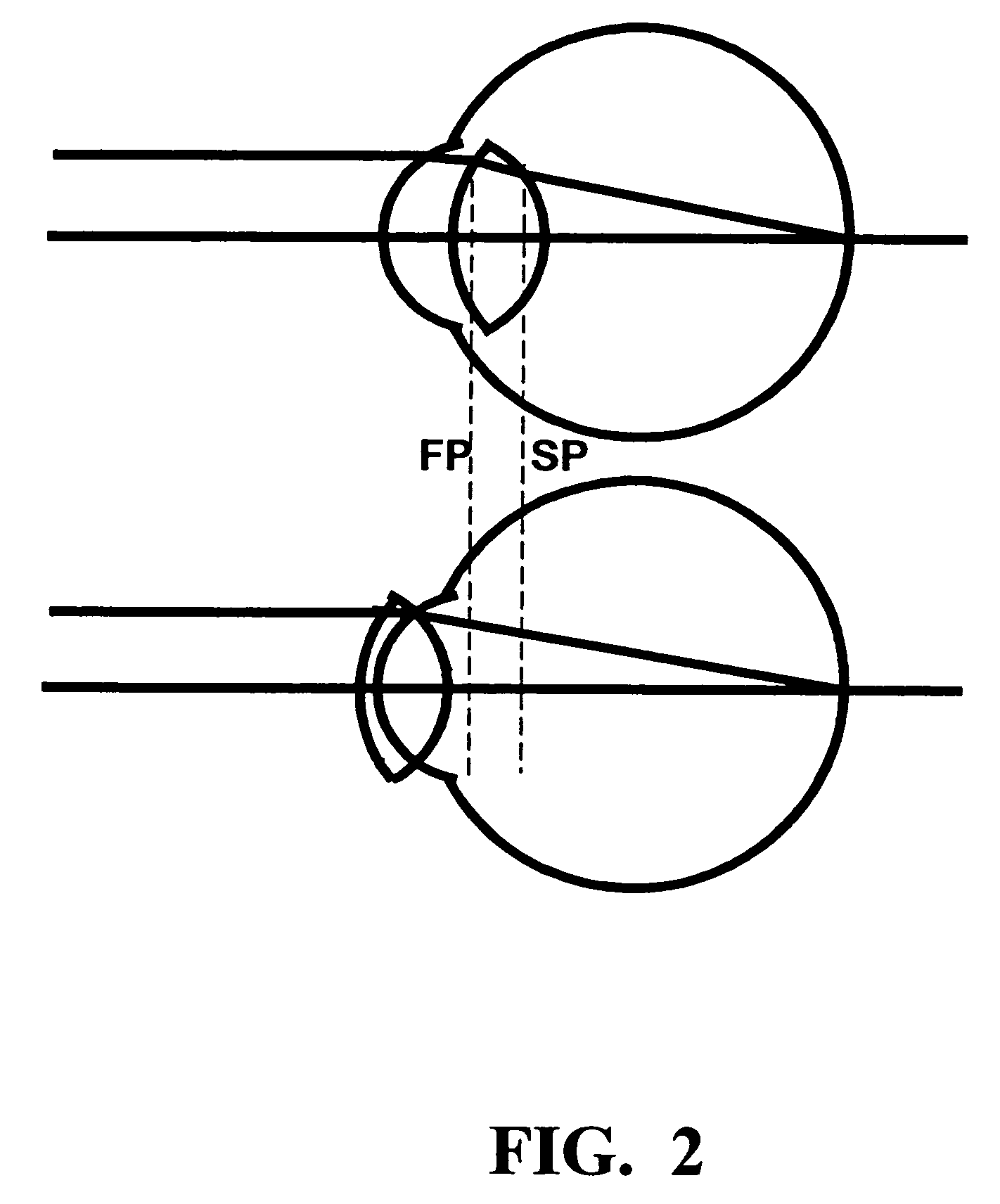 Method of calculating the required lens power for an opthalmic implant