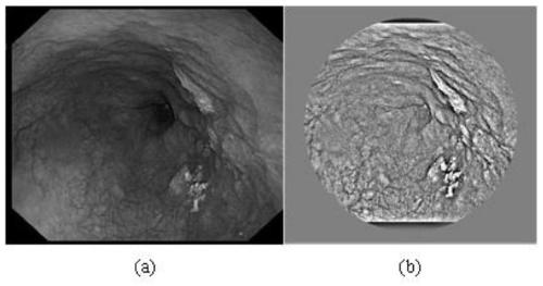 Lesion image classification method based on convolutional neural network