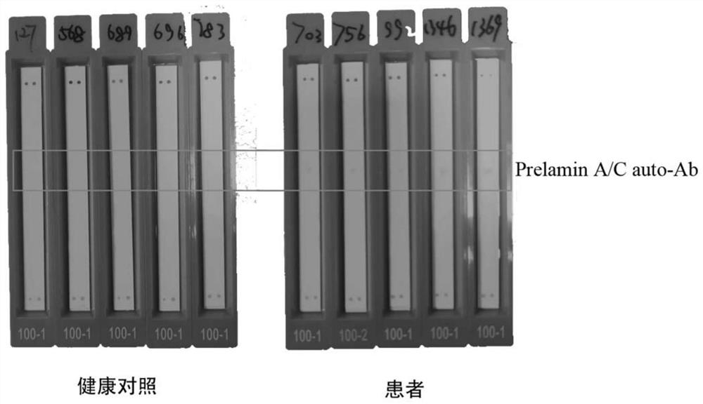 A test kit for detecting anti-prelamin A/C-IgG antibody