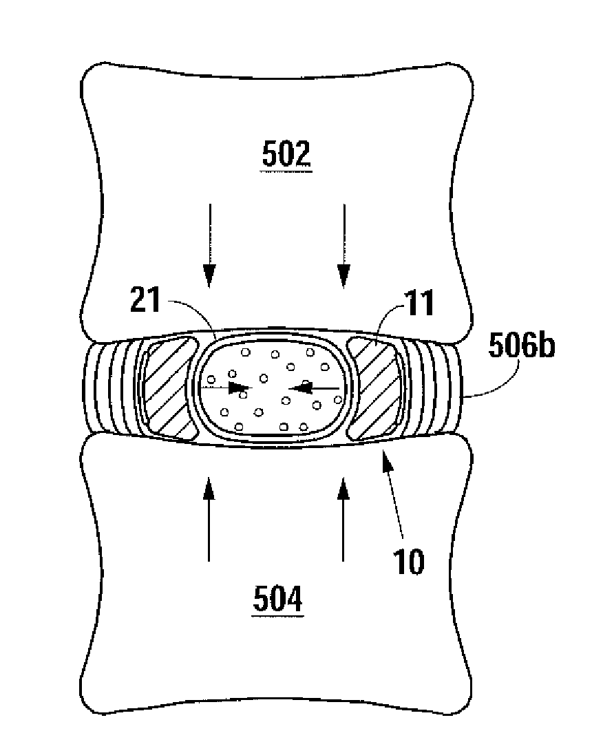 Percutaneous Implantable Nuclear Prosthesis