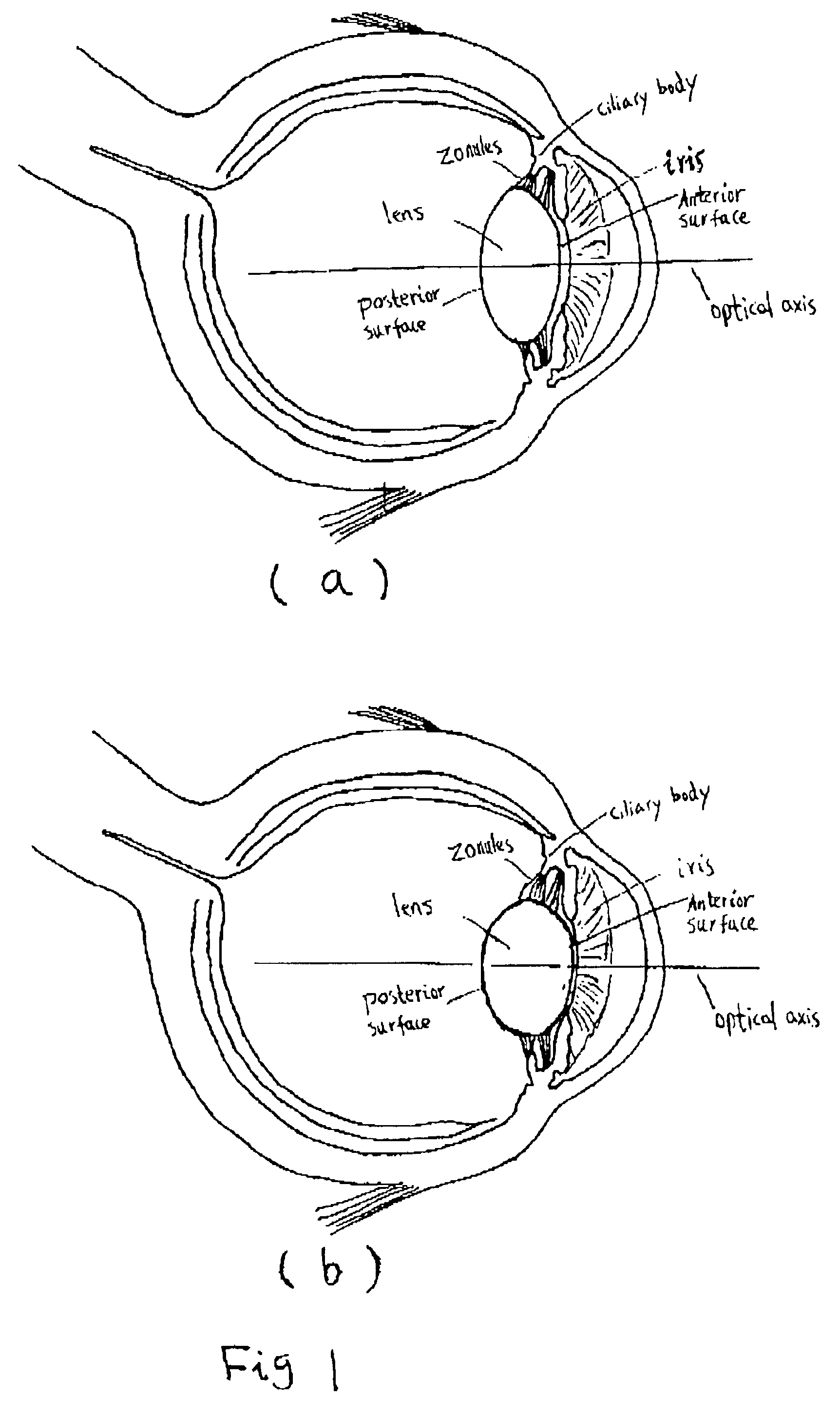 Accommodative intraocular lens