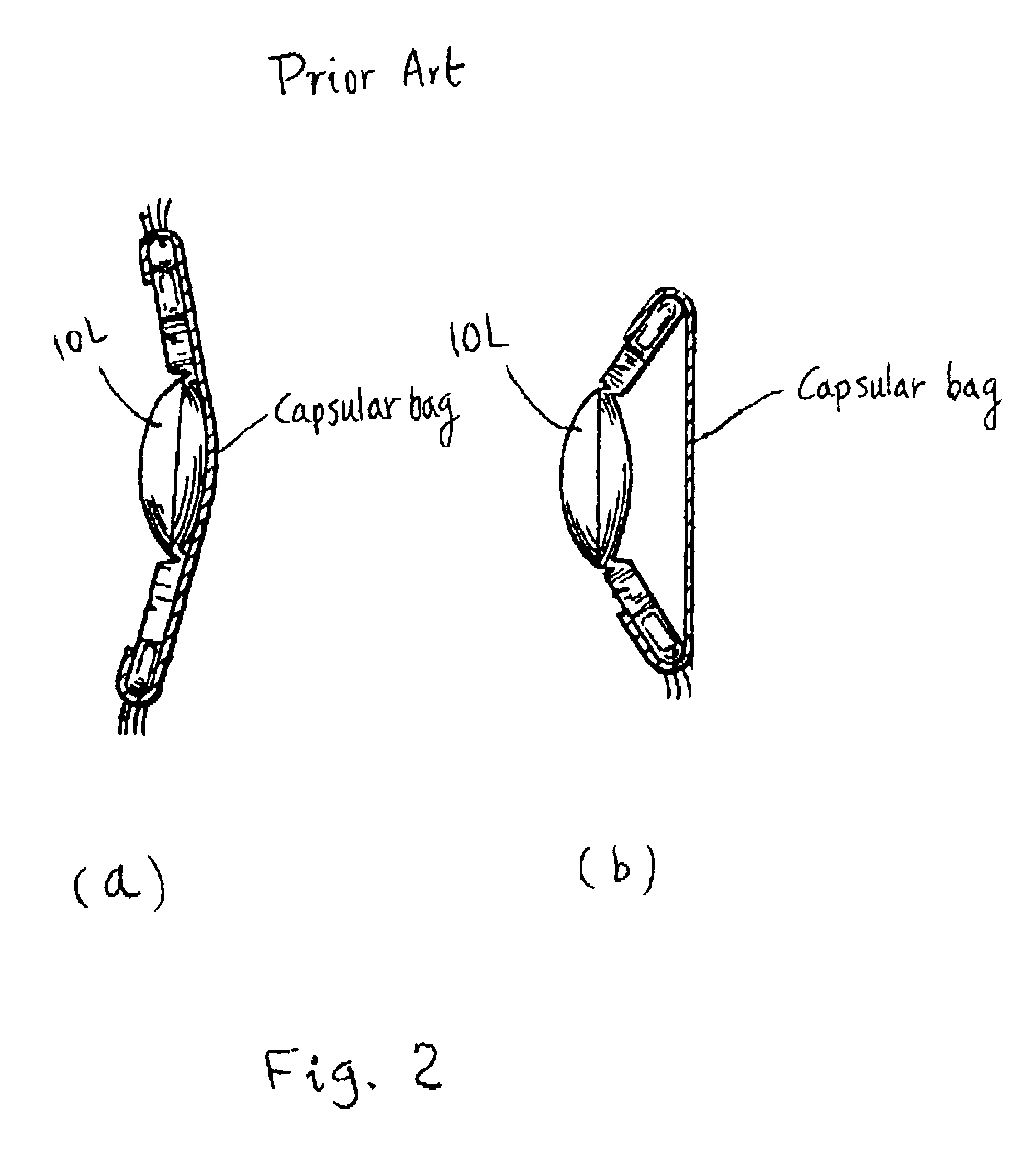 Accommodative intraocular lens