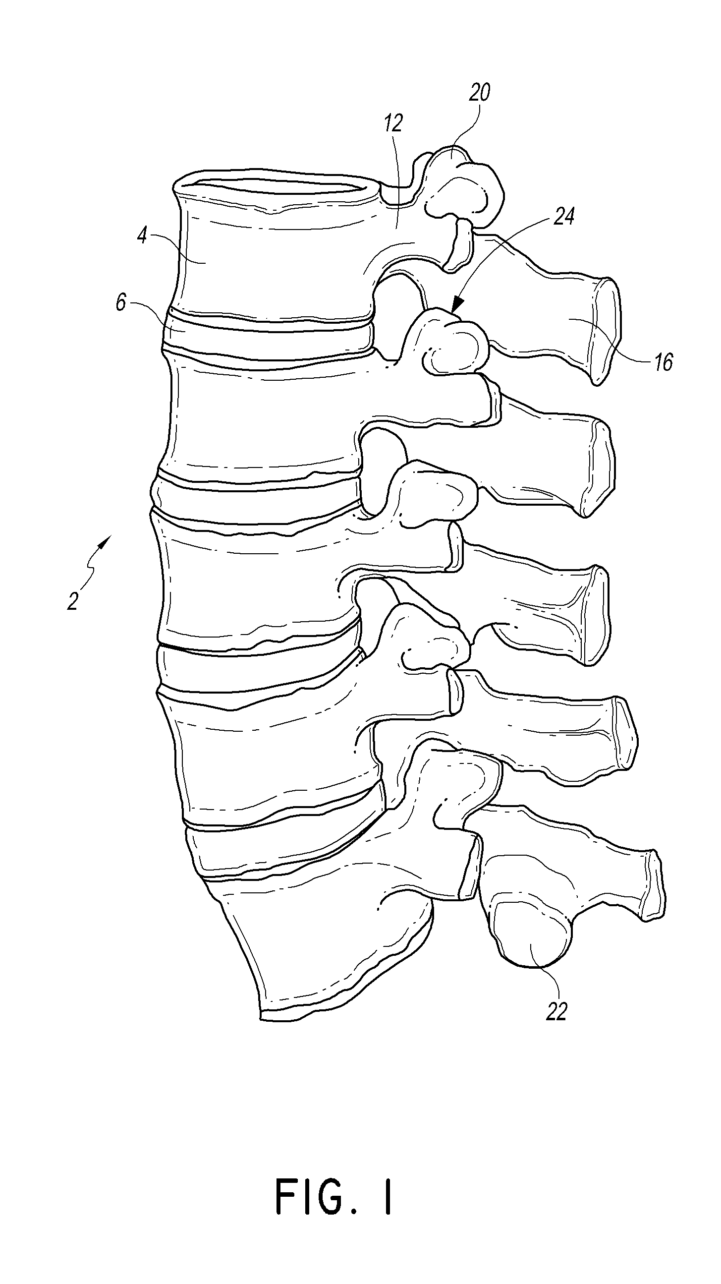 Facet joint implant