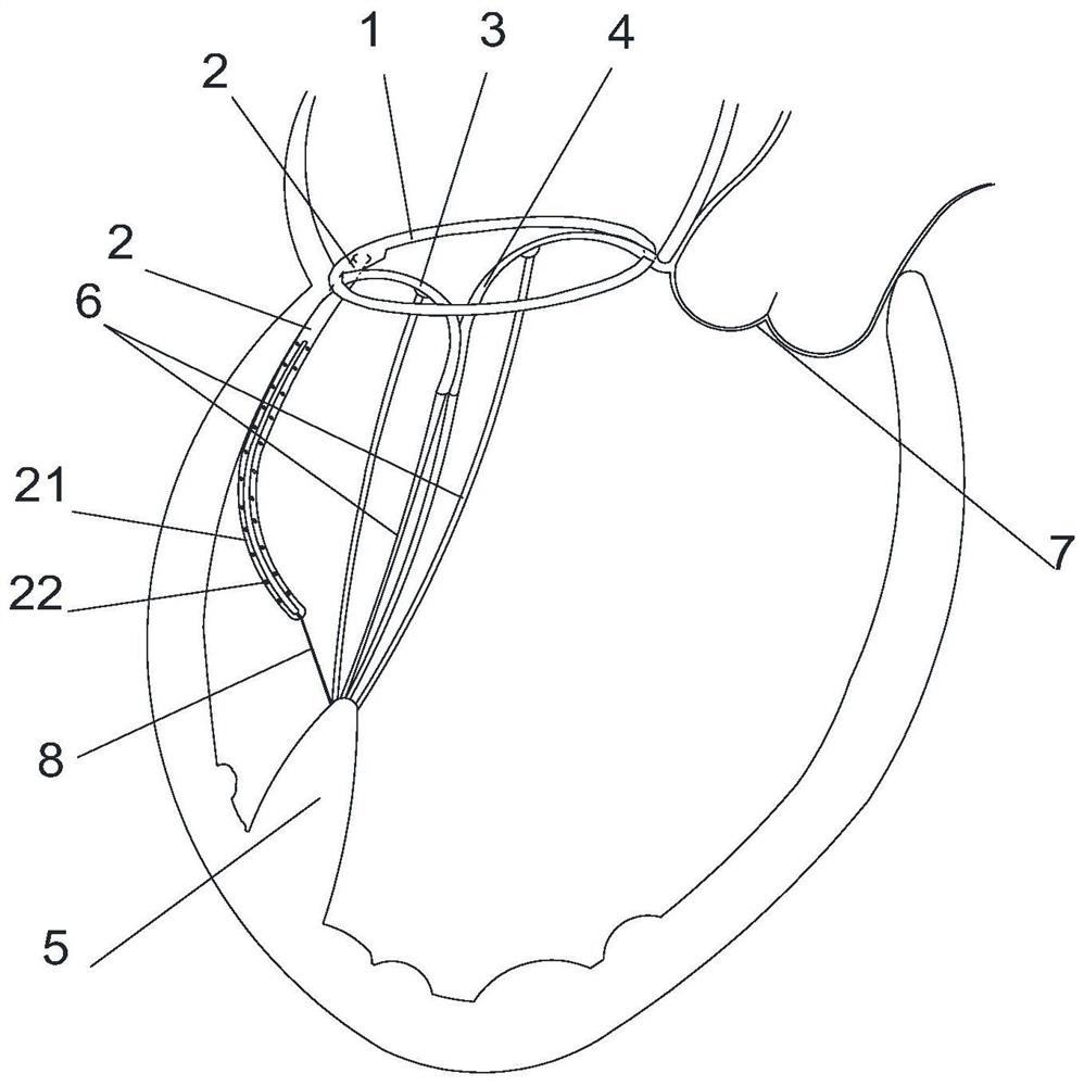 Multifunctional mitral valvuloplasty device