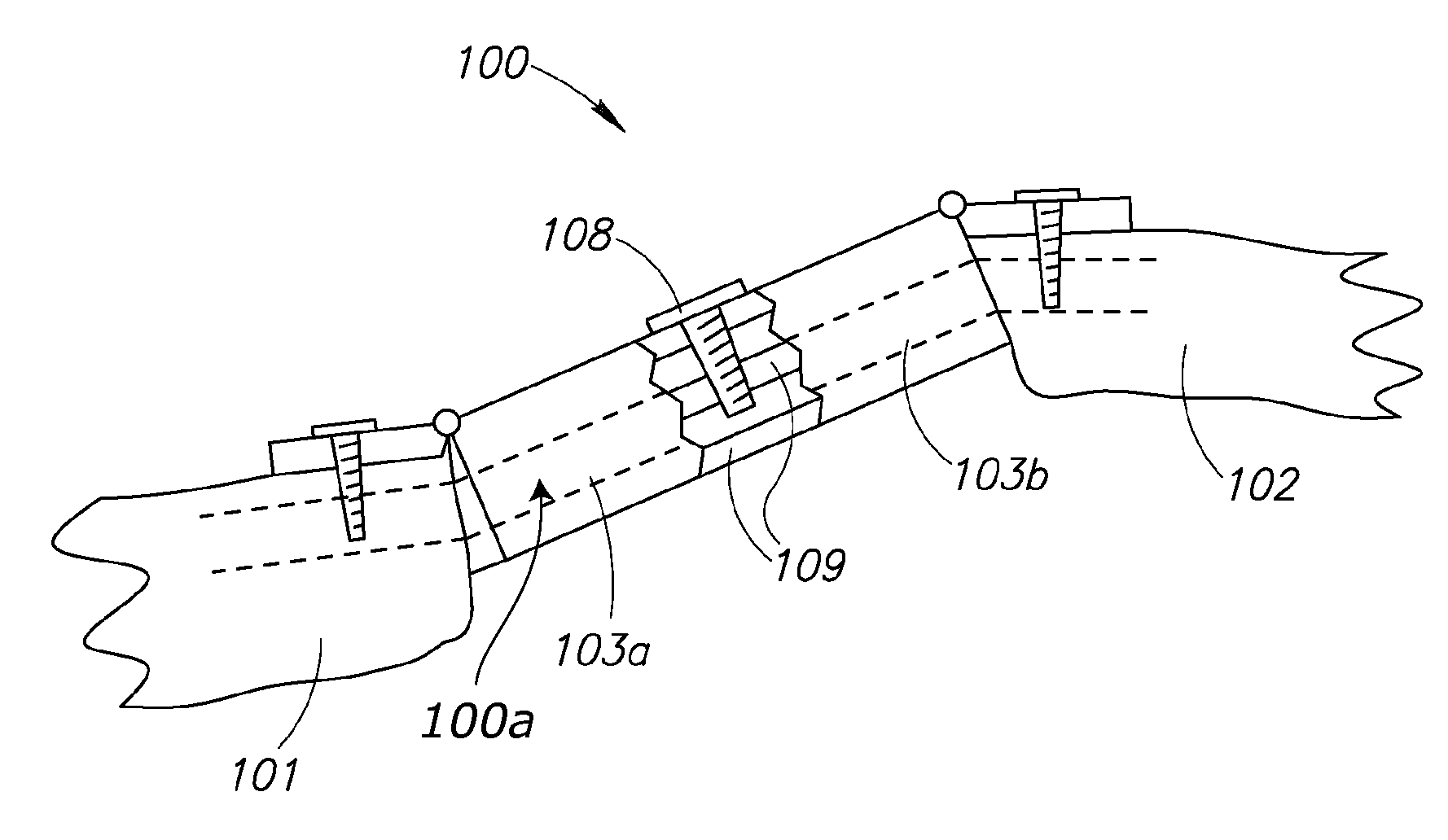 Device for expandable spinal laminoplasty