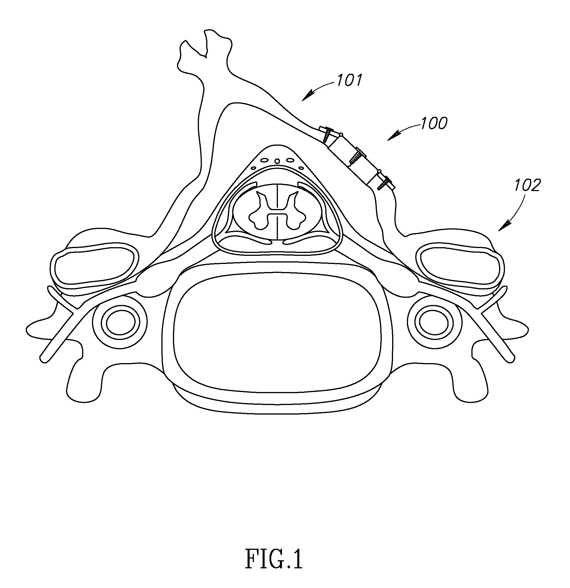 Device for expandable spinal laminoplasty