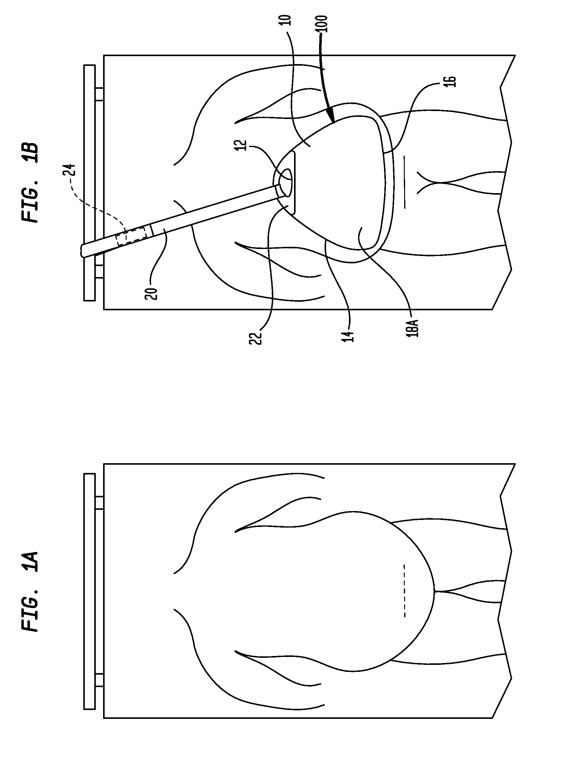 Abdominal elevator