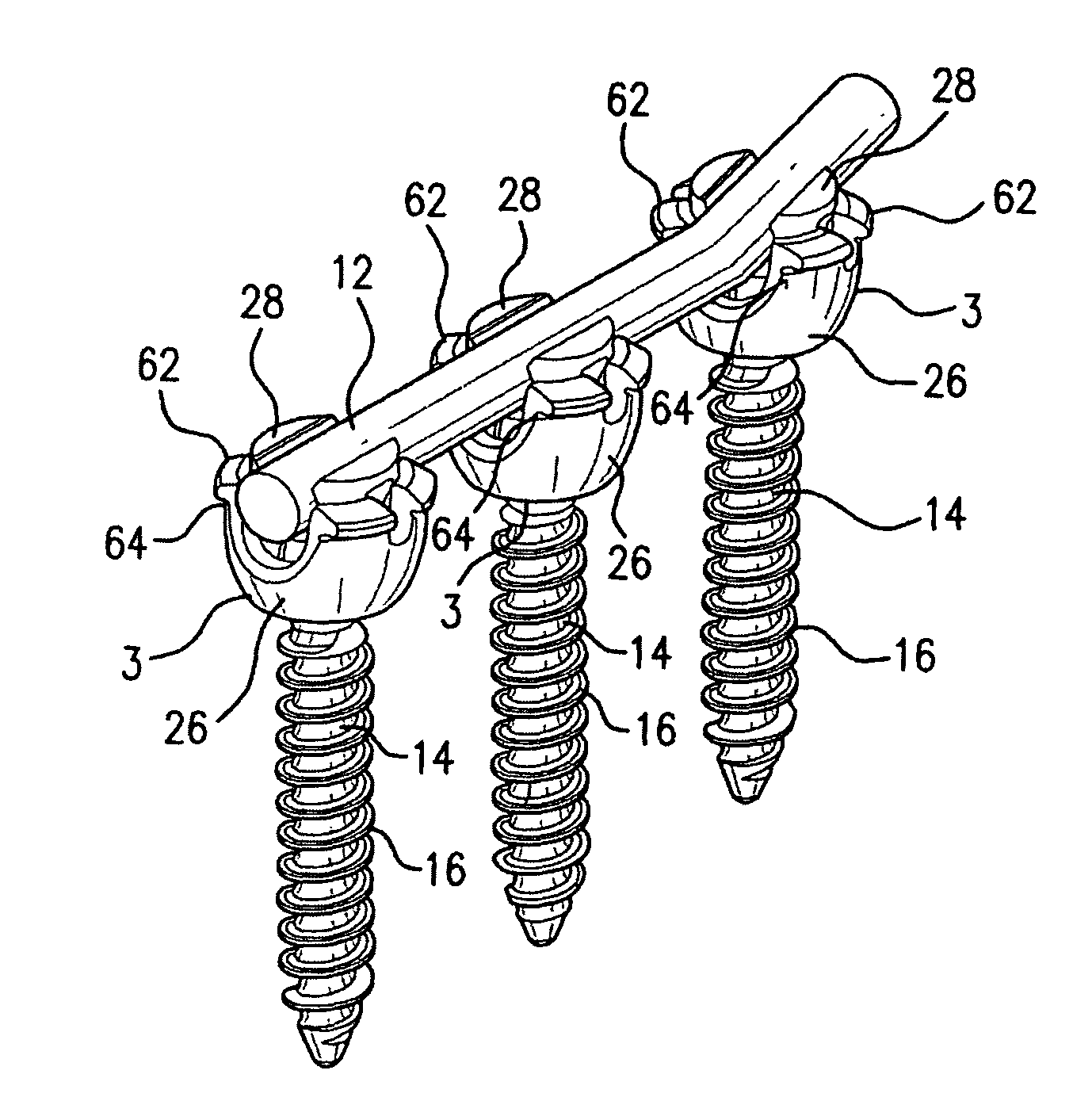 Spinal fixation system having locking and unlocking devices for use with a multi-planar, taper lock screw