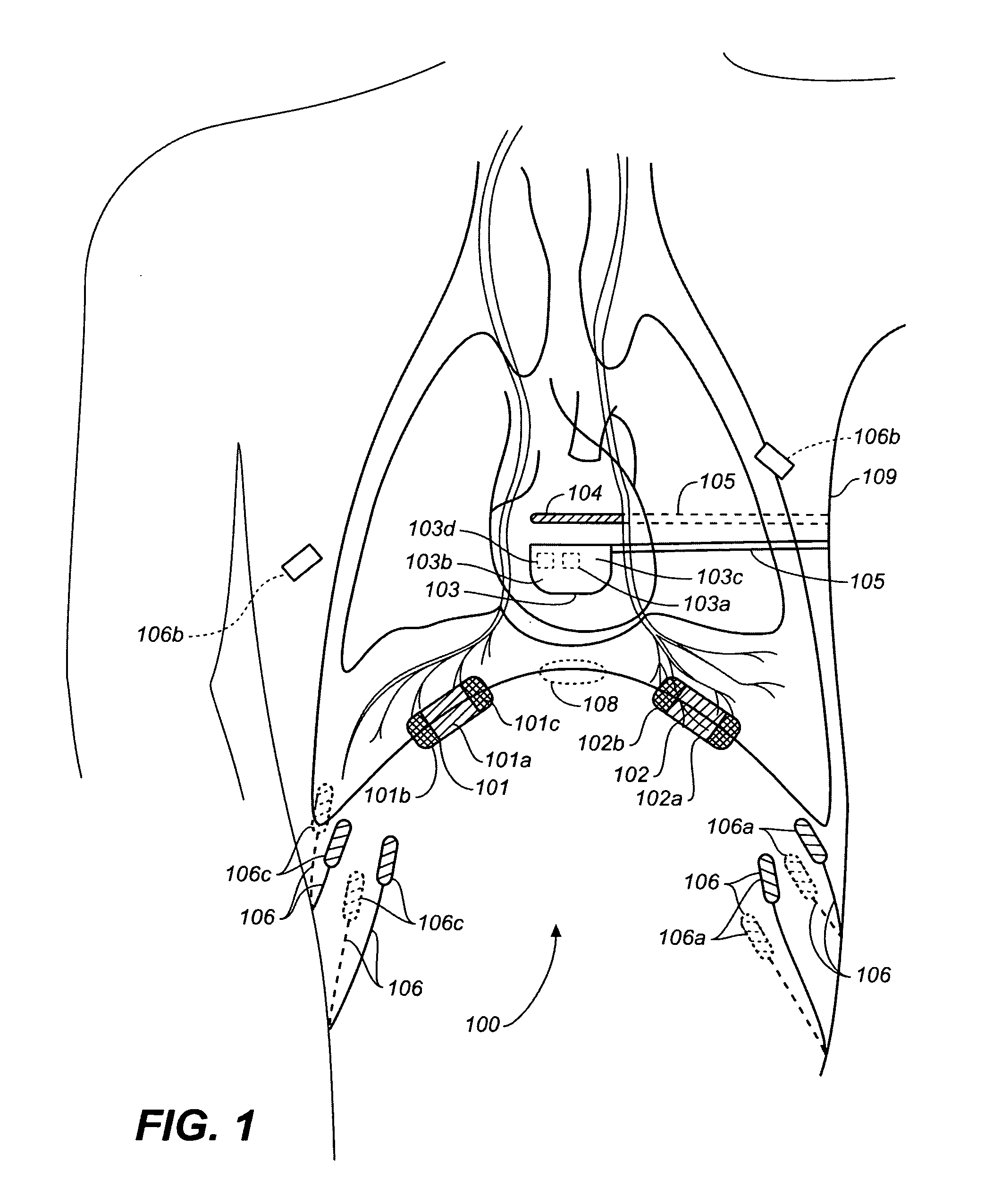 Subcutaneous diaphragm stimulation device and method for use