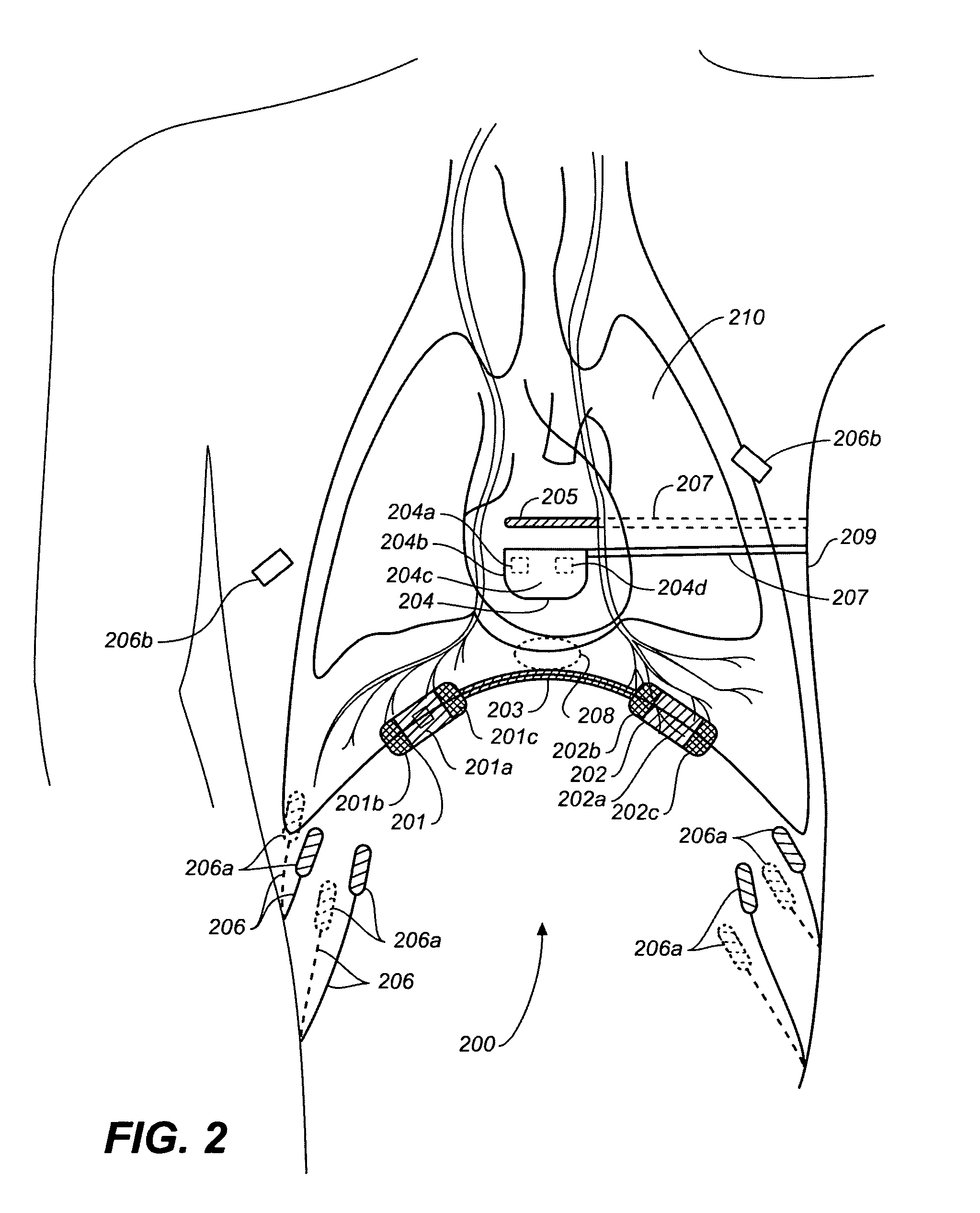 Subcutaneous diaphragm stimulation device and method for use