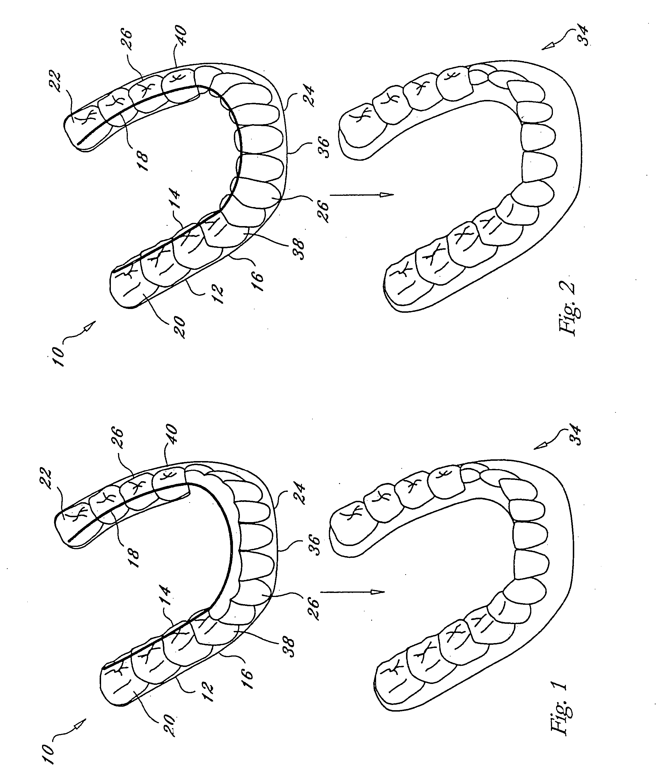 Orthodontic appliance with embedded wire for moving teeth