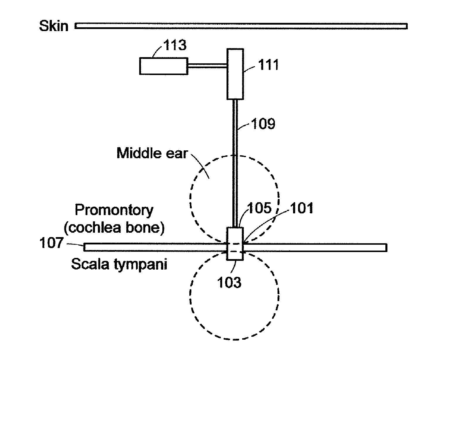 Implantable Neuro-Stimulation Electrode with Drug Elution Material