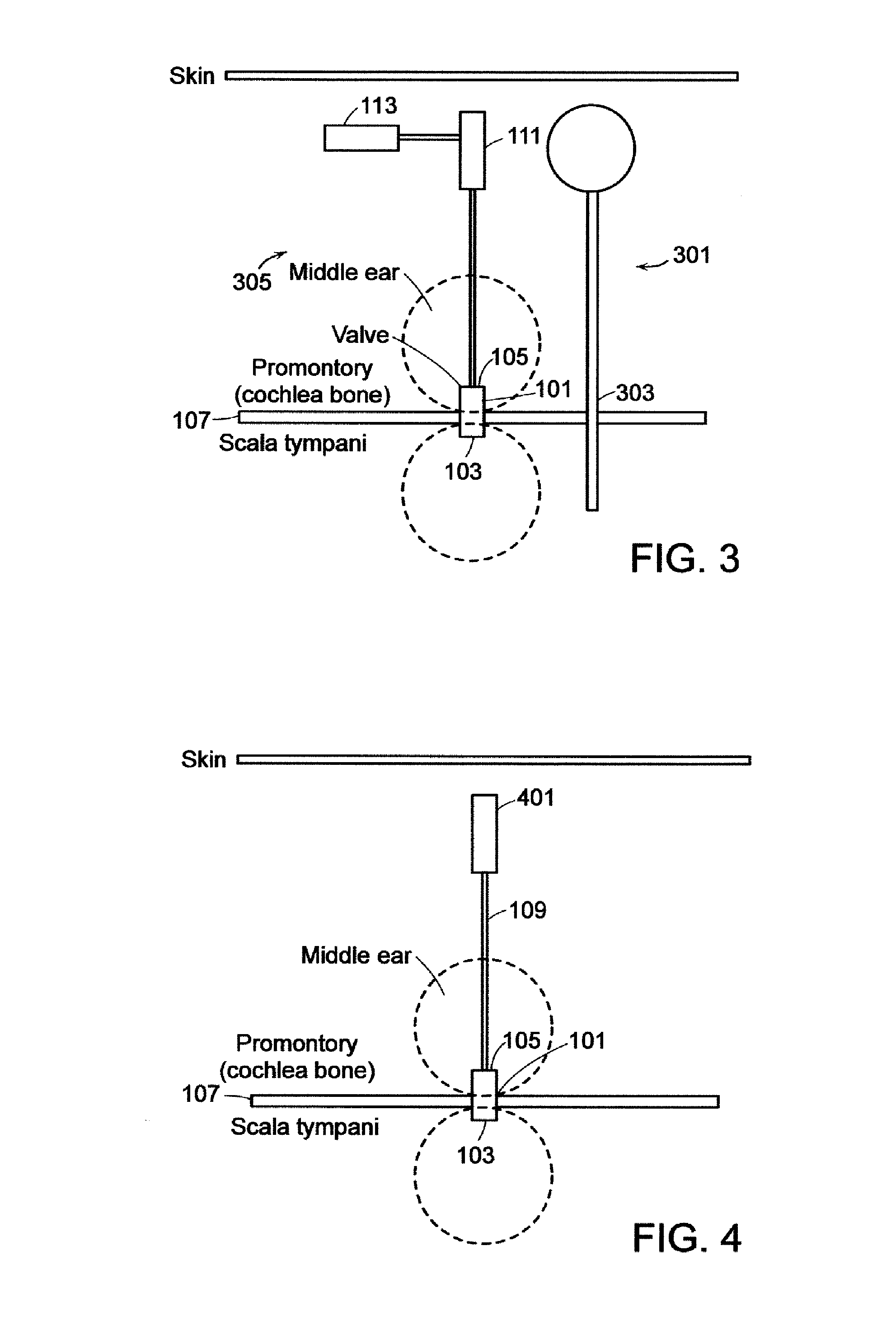 Implantable Neuro-Stimulation Electrode with Drug Elution Material