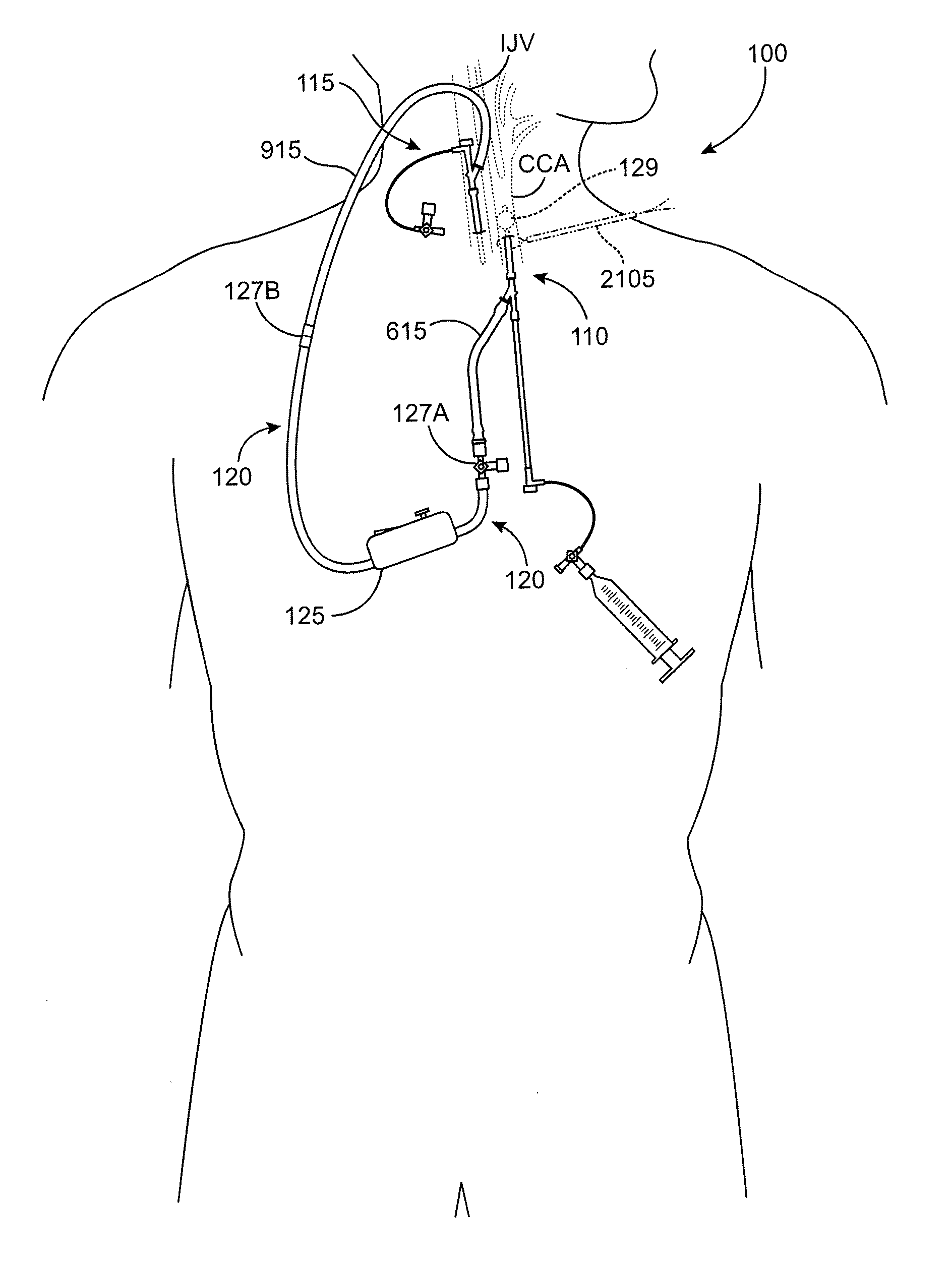 Methods and systems for establishing retrograde carotid arterial blood flow