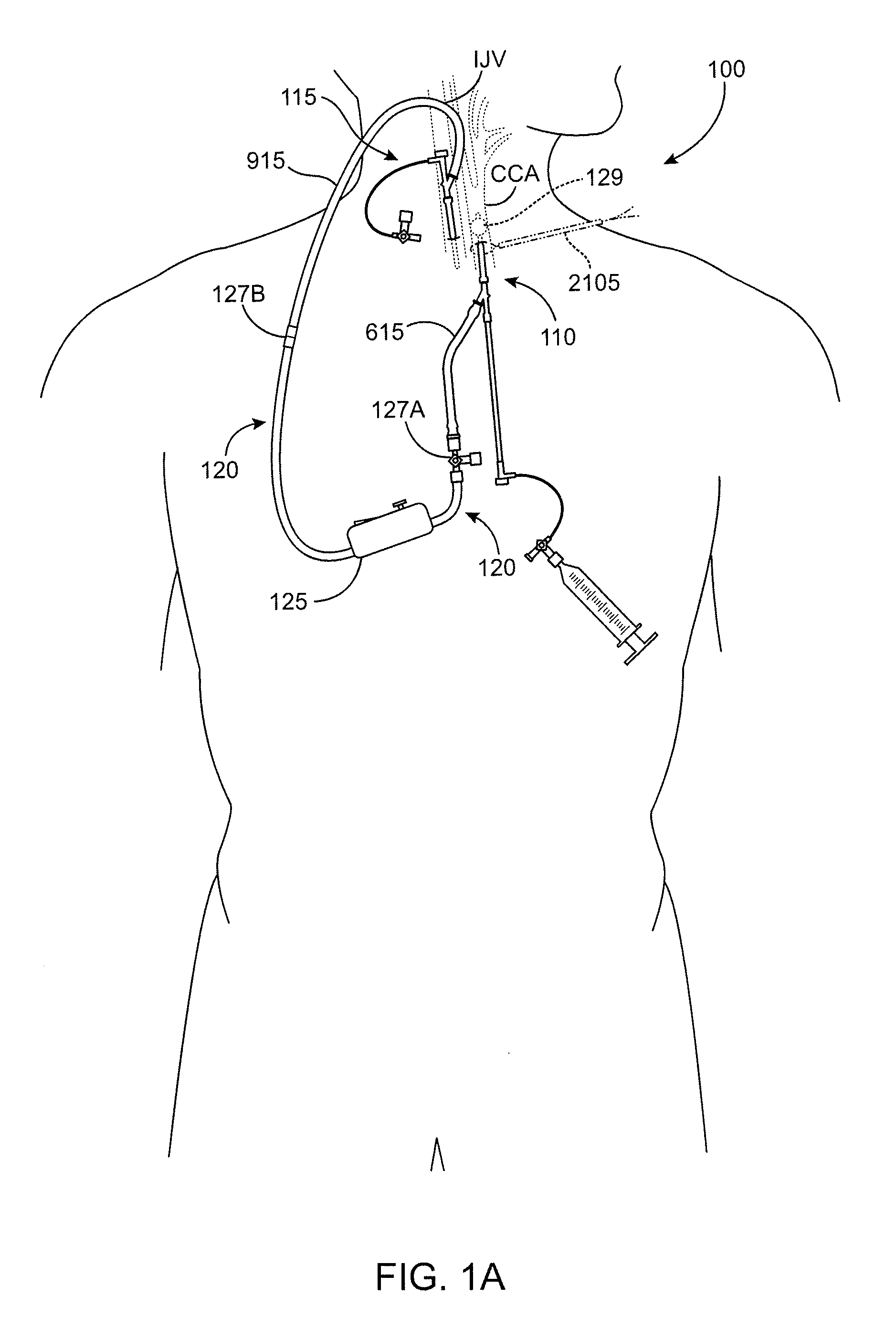 Methods and systems for establishing retrograde carotid arterial blood flow