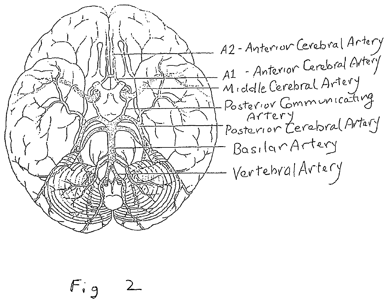 Methods and devices to ameliorate vascular obstruction