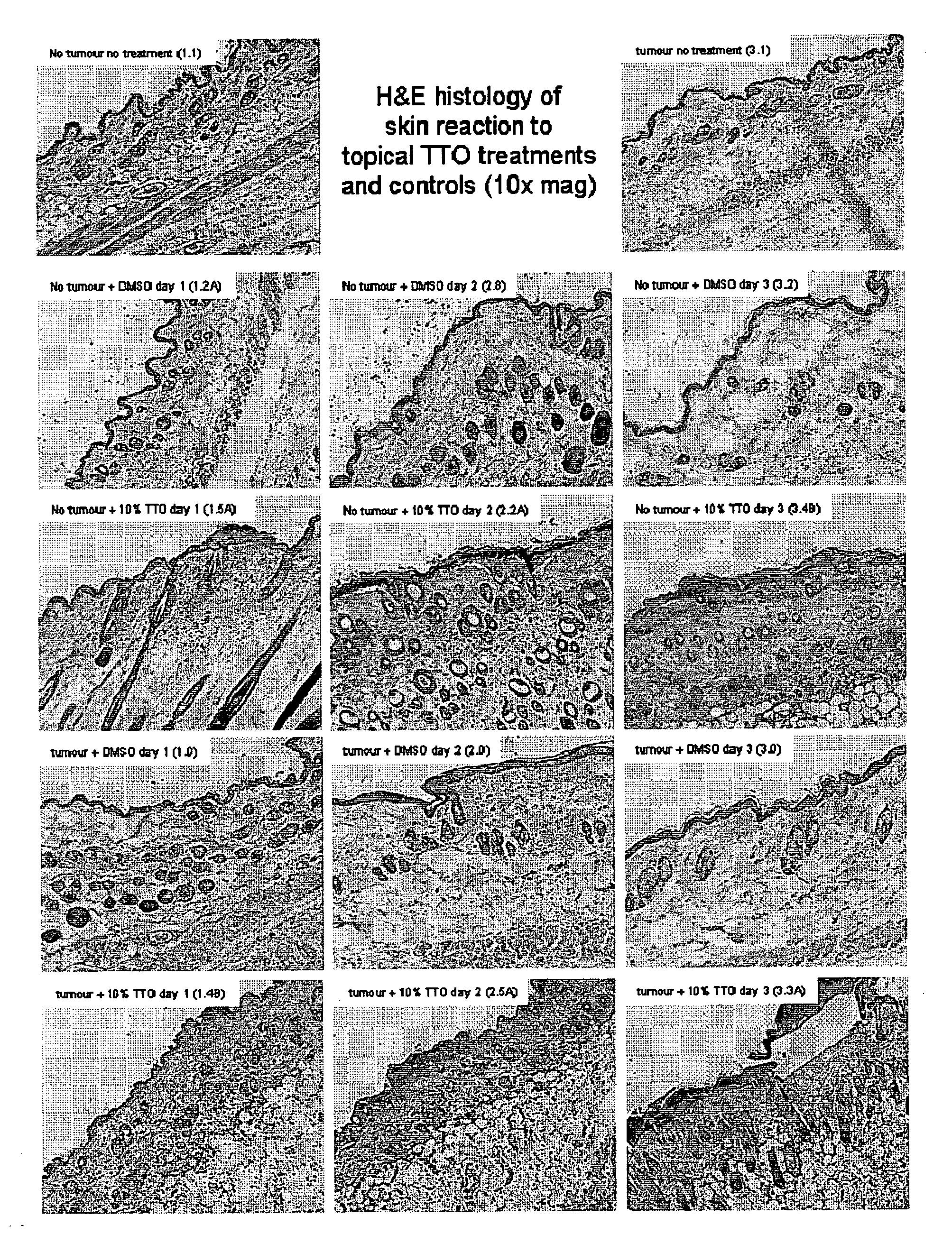 Compositions Comprising Tea Tree Oil and Methods for the Prevention and Treatment of Cancer