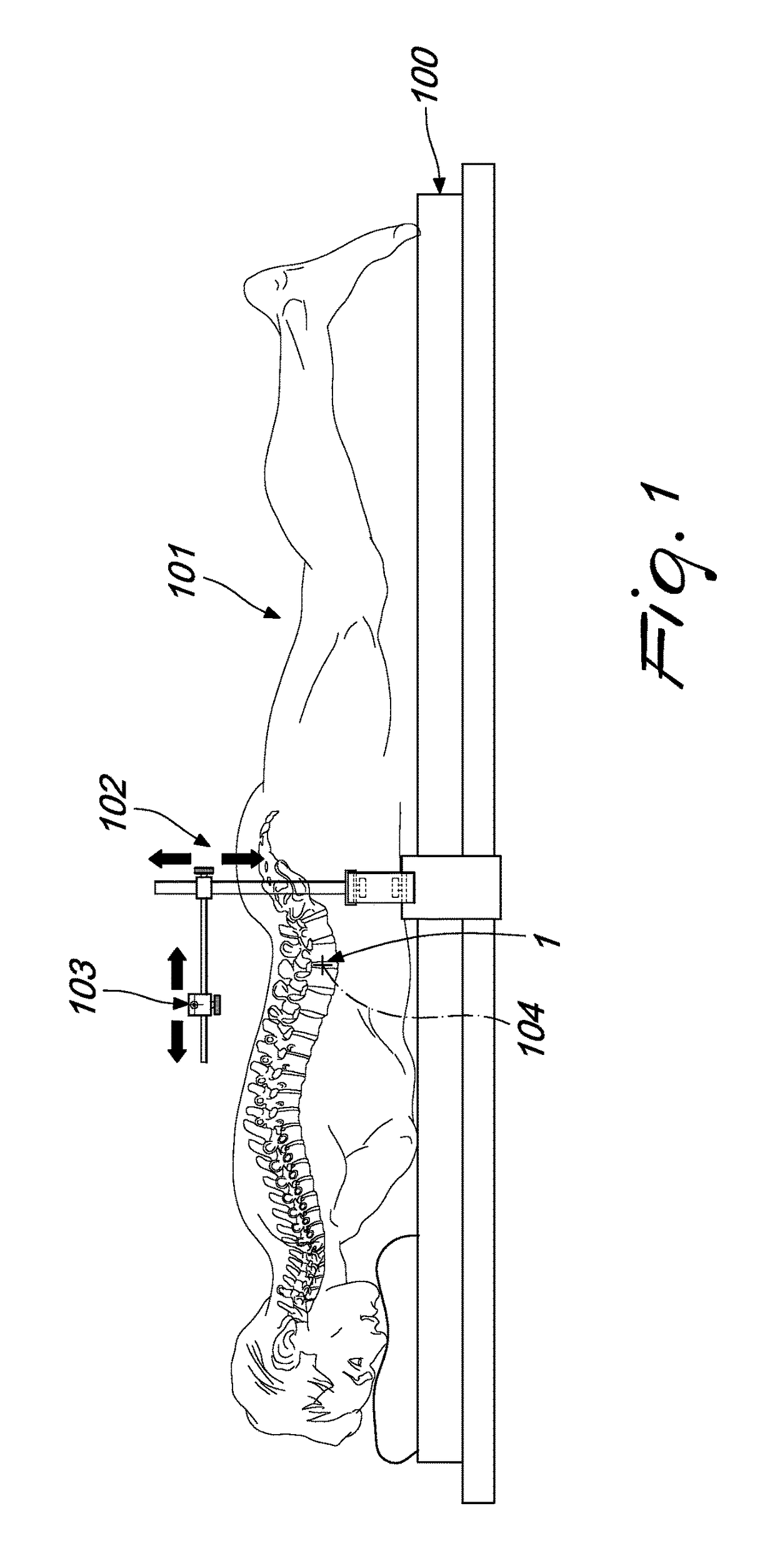 Intervertebral prosthesis, apparatus for implanting intervertebral prostheses and surgical method for implanting intervertebral prostheses, particularly for percutaneous minimally-invasive surgical procedures