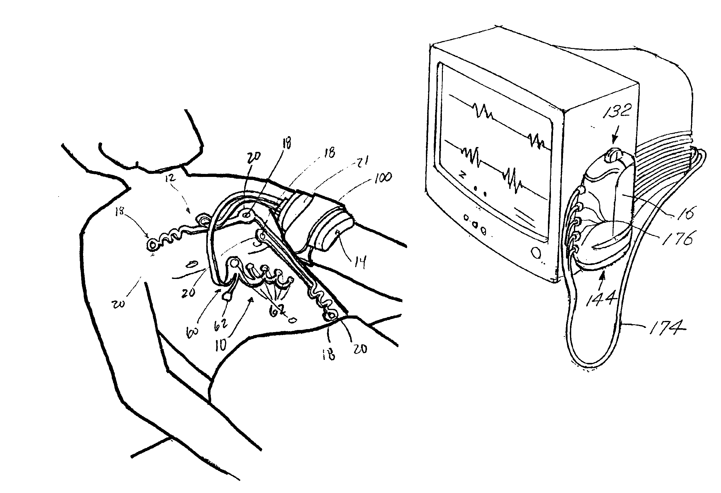 Wireless ECG system