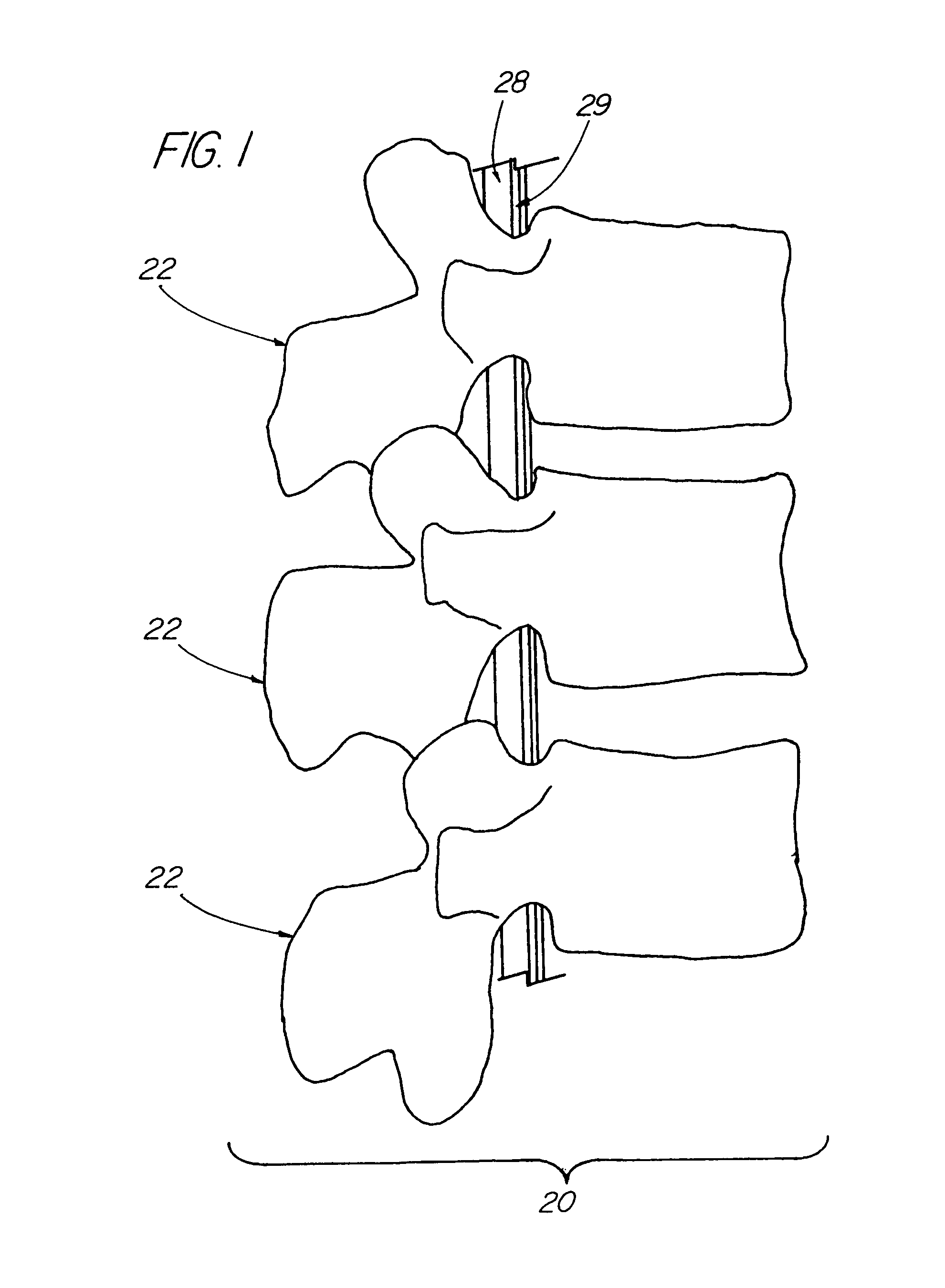 Apparatus for strengthening vertebral bodies