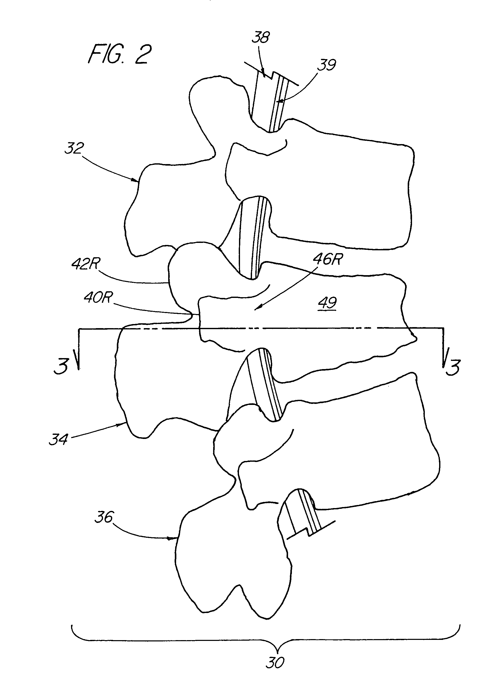 Apparatus for strengthening vertebral bodies