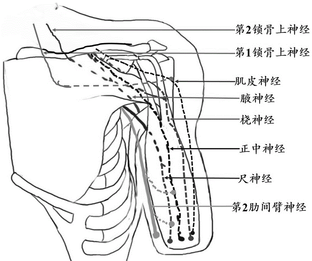 Method for reconstructing sensory nerve functions of amputation upper limbs and method for sensory nerve and artificial limb interfaces