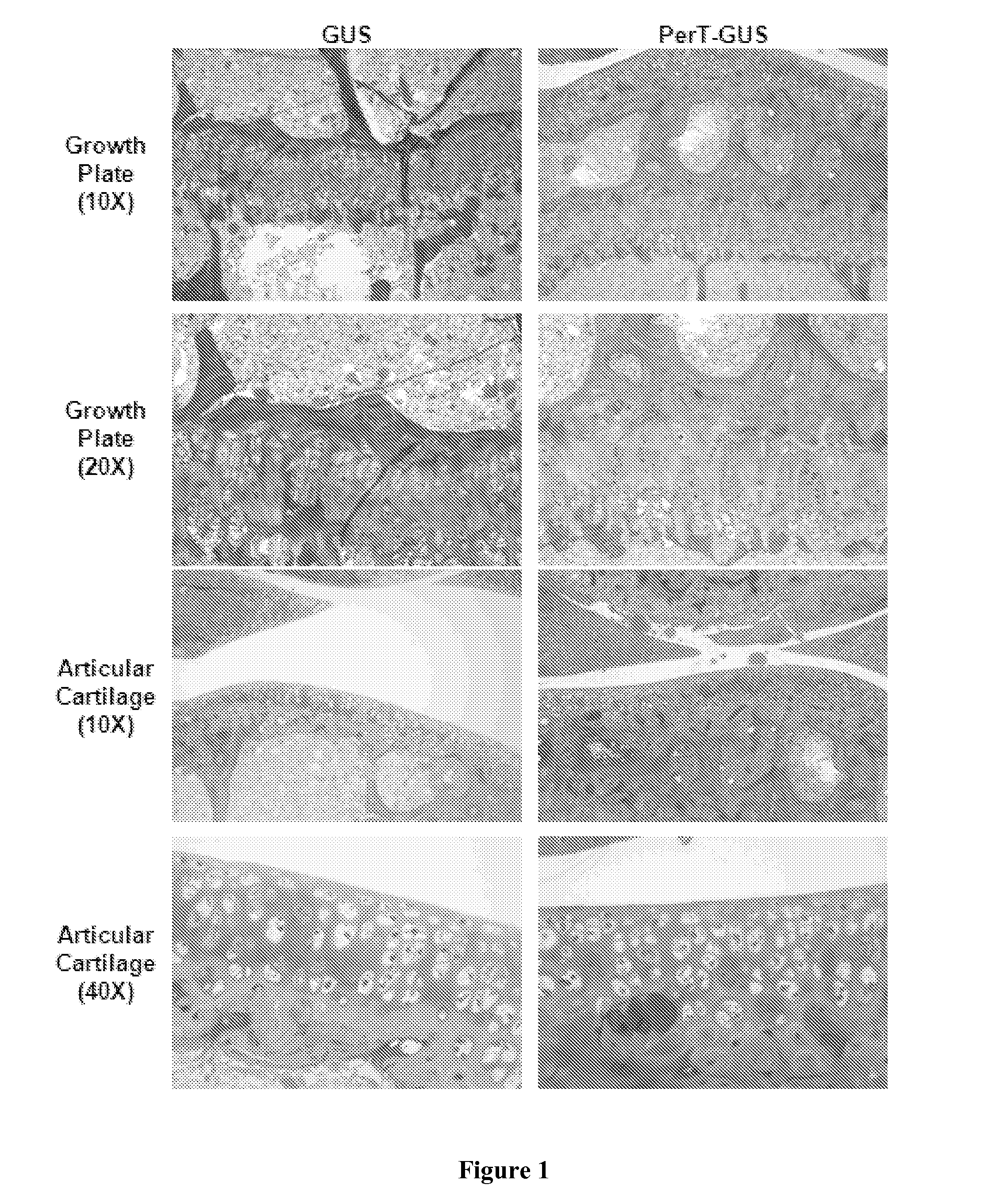 Enzyme replacement therapy for treating MPS vii related bone lesions using a chemically modified enzyme