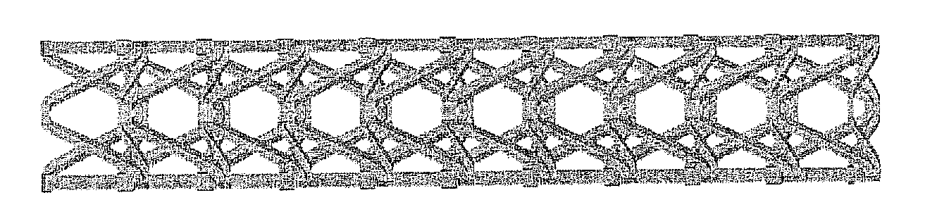 Auxetic stents