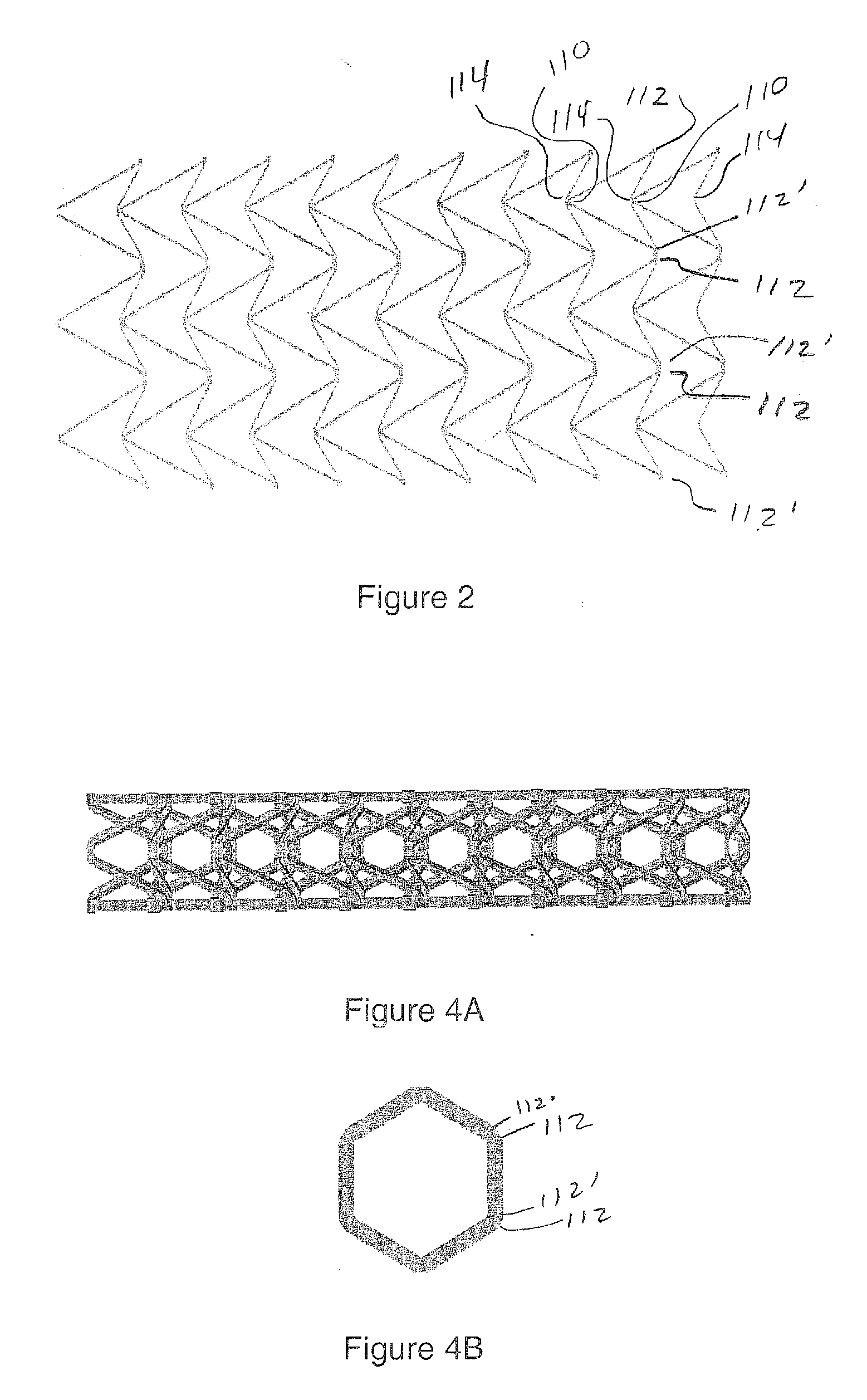 Auxetic stents