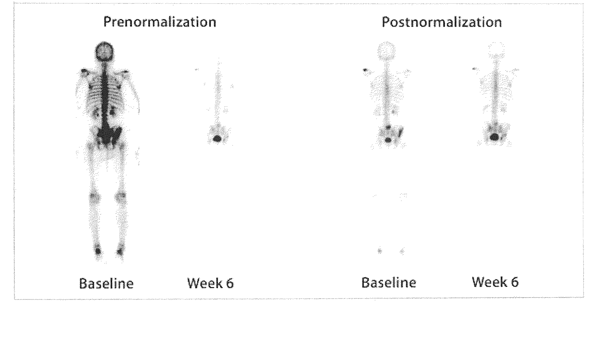 Method of Quantifying Cancer Treatment