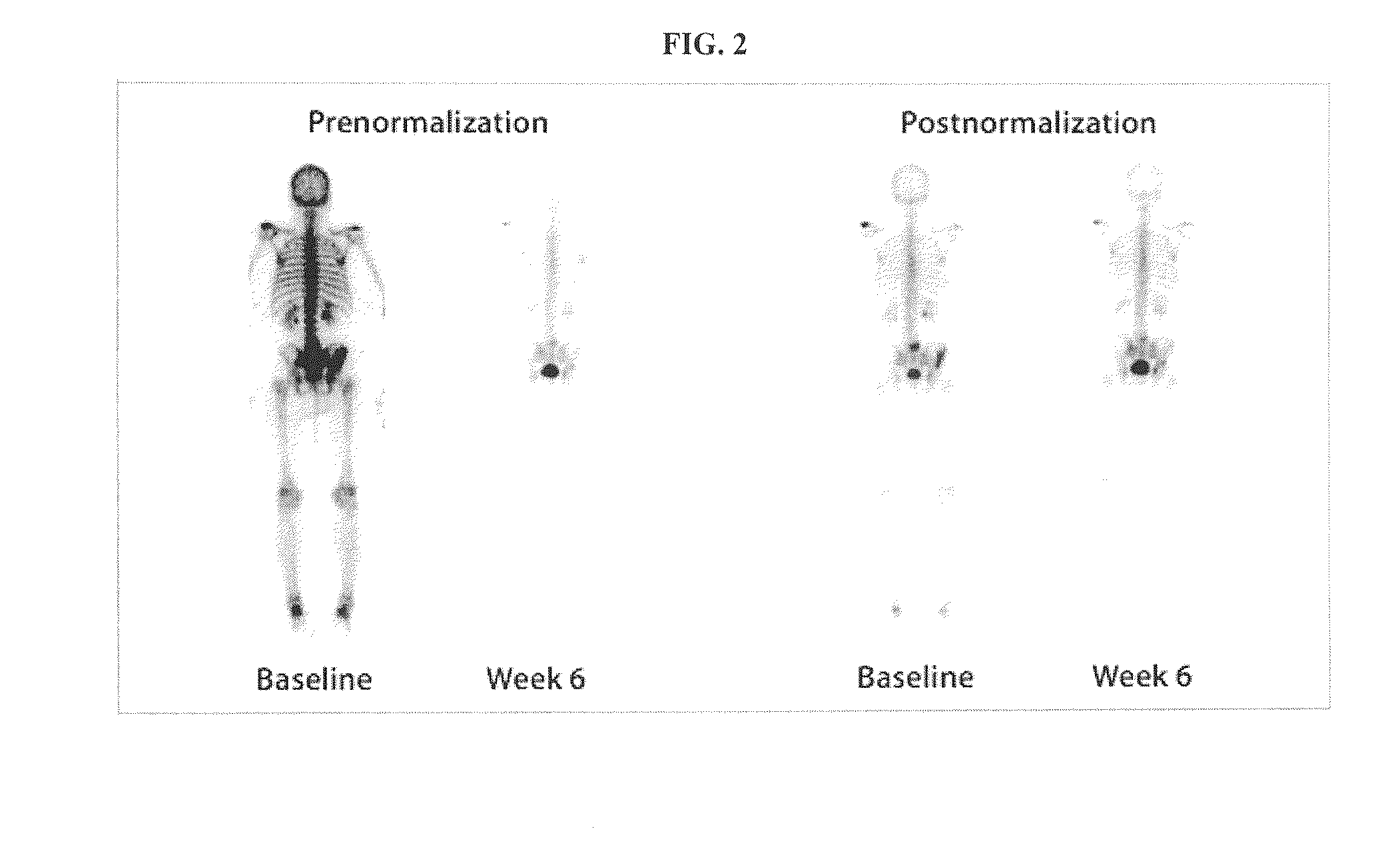 Method of Quantifying Cancer Treatment