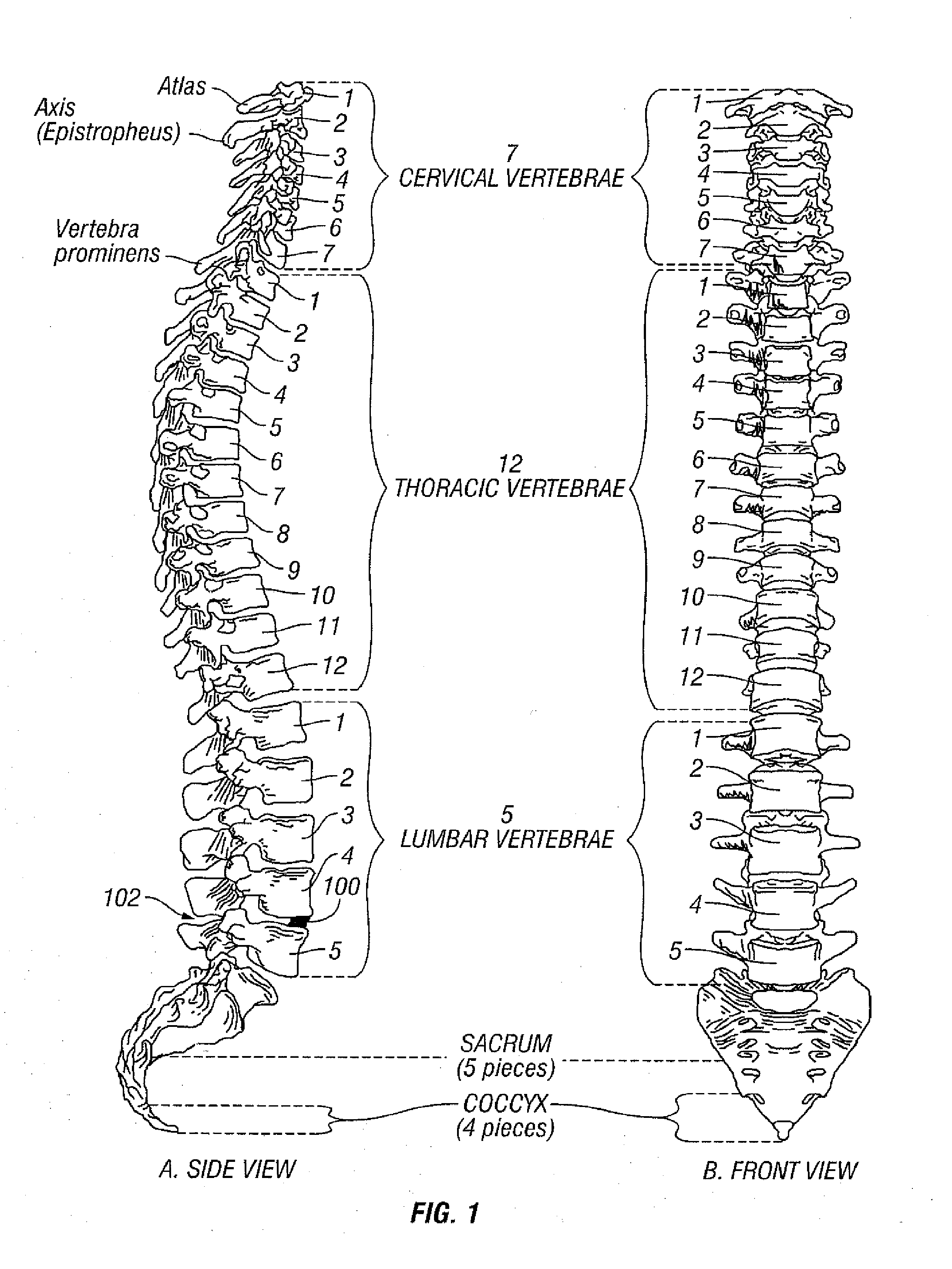 Selectively Expanding Spine Cage, Hydraulically Controllable In Three Dimensions for Vertebral Body Replacement