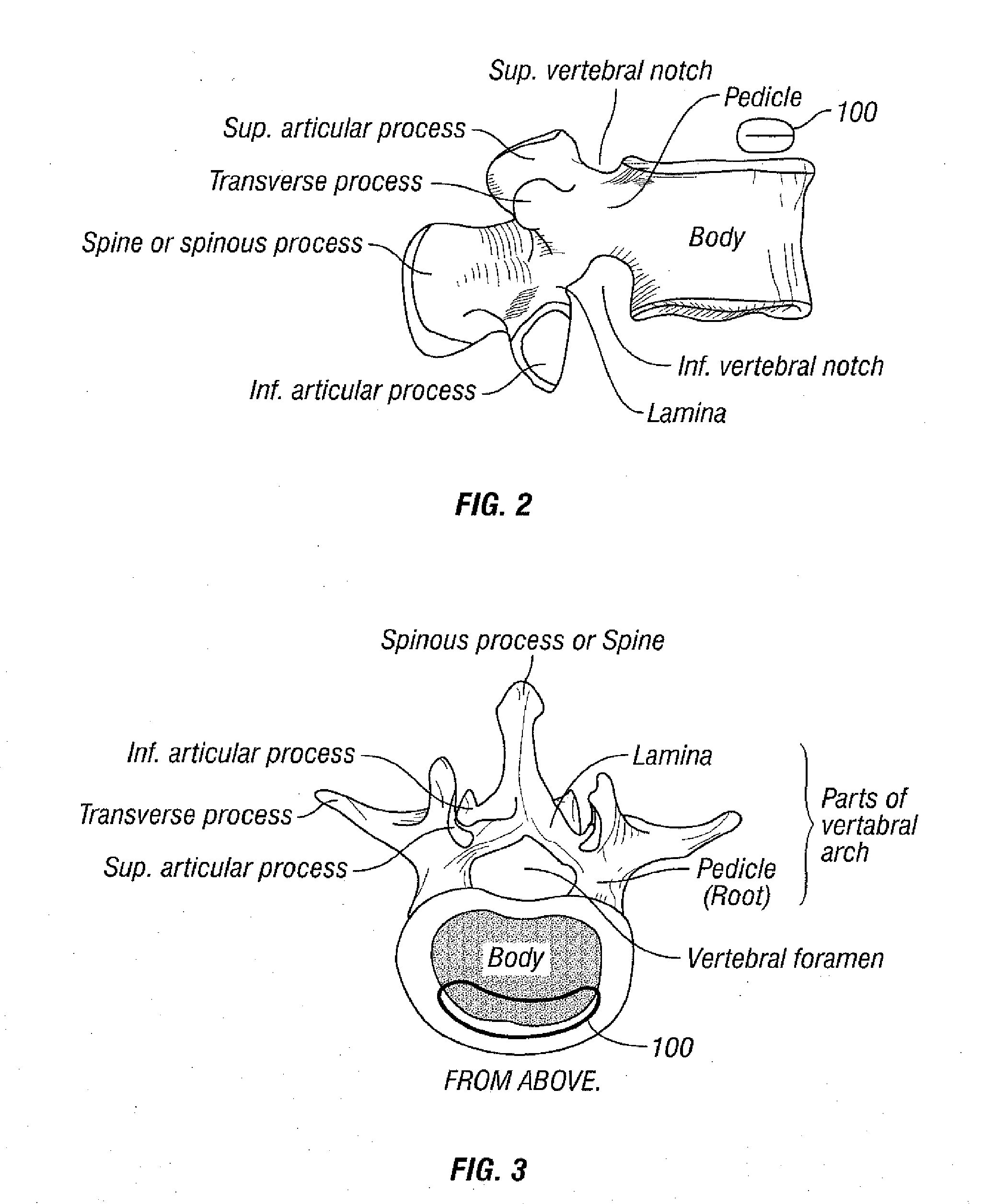 Selectively Expanding Spine Cage, Hydraulically Controllable In Three Dimensions for Vertebral Body Replacement