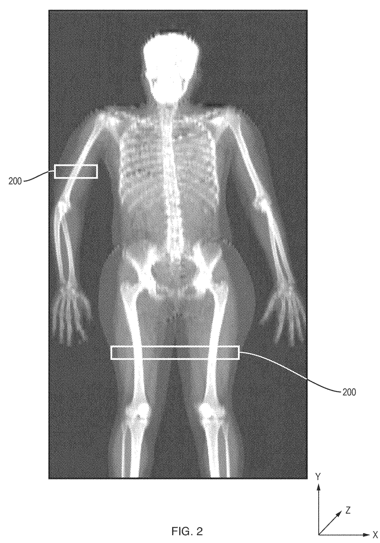 Measuring intramuscular fat