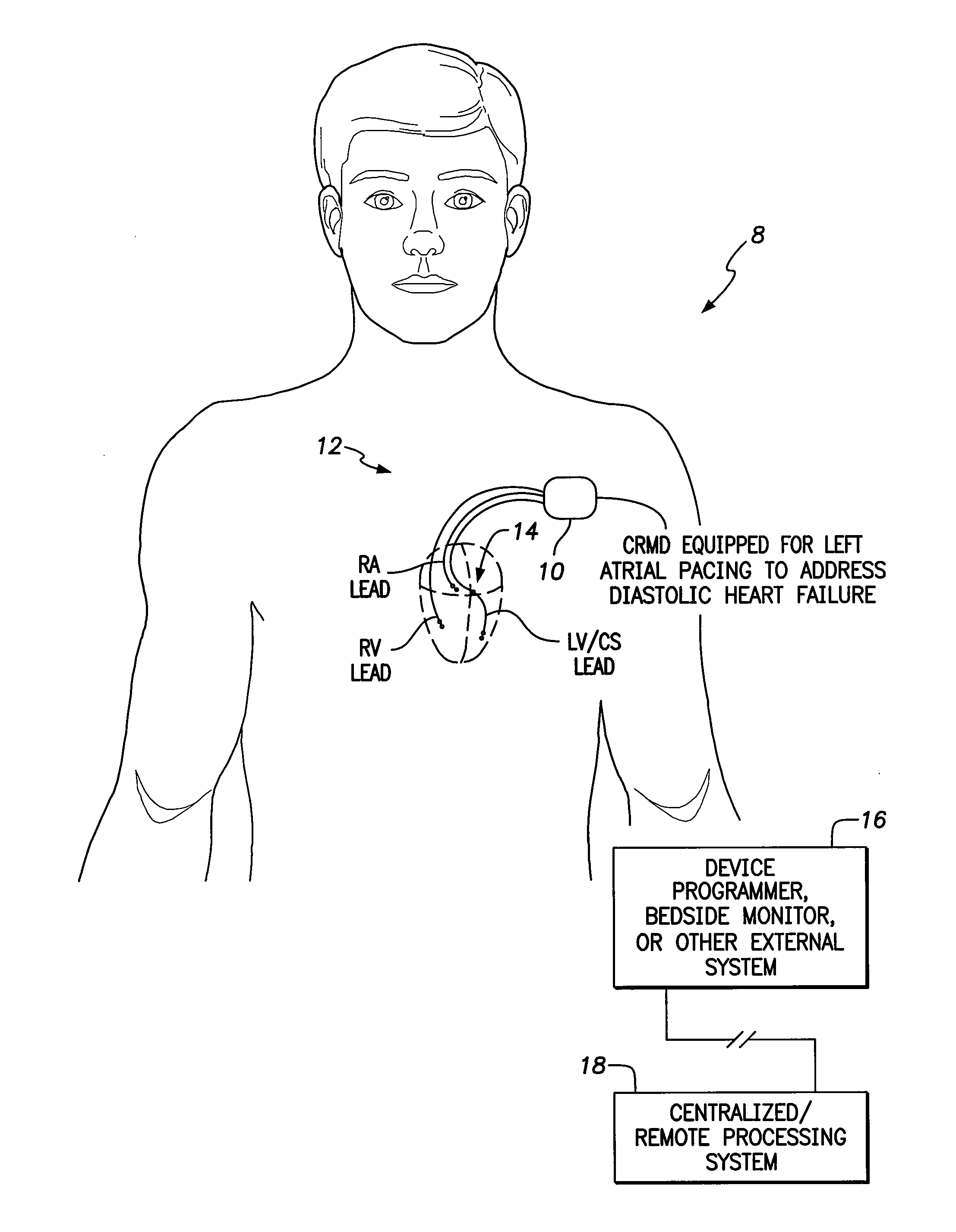 System and method for left atrial pacing in patients with diastolic heart failure